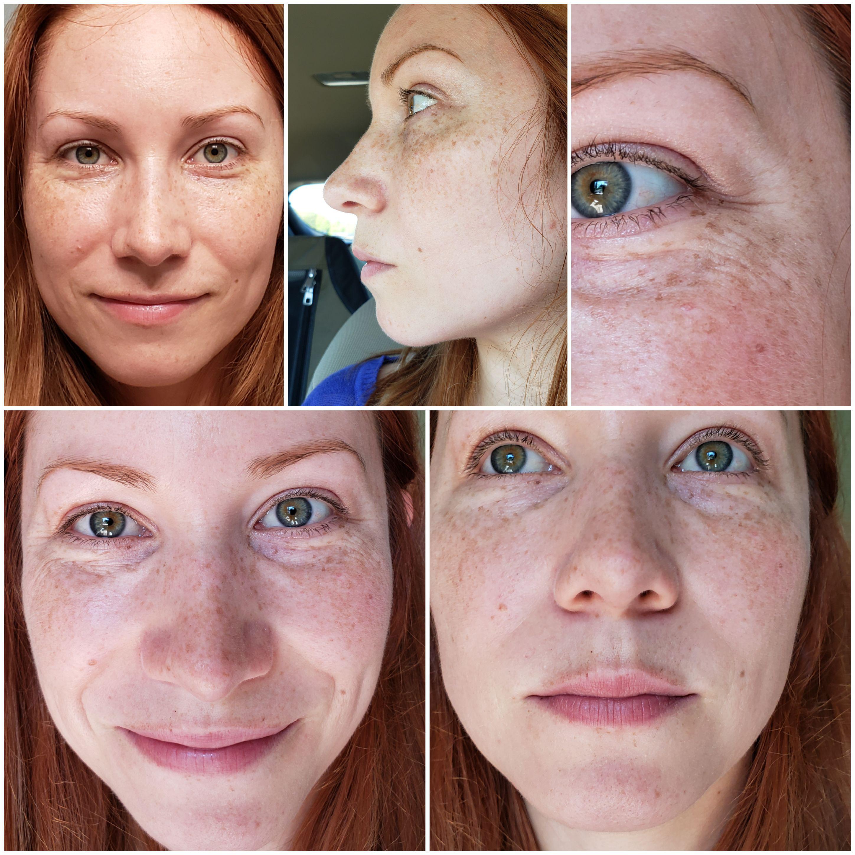 I'm thinking about getting filler around my eyes and mouth