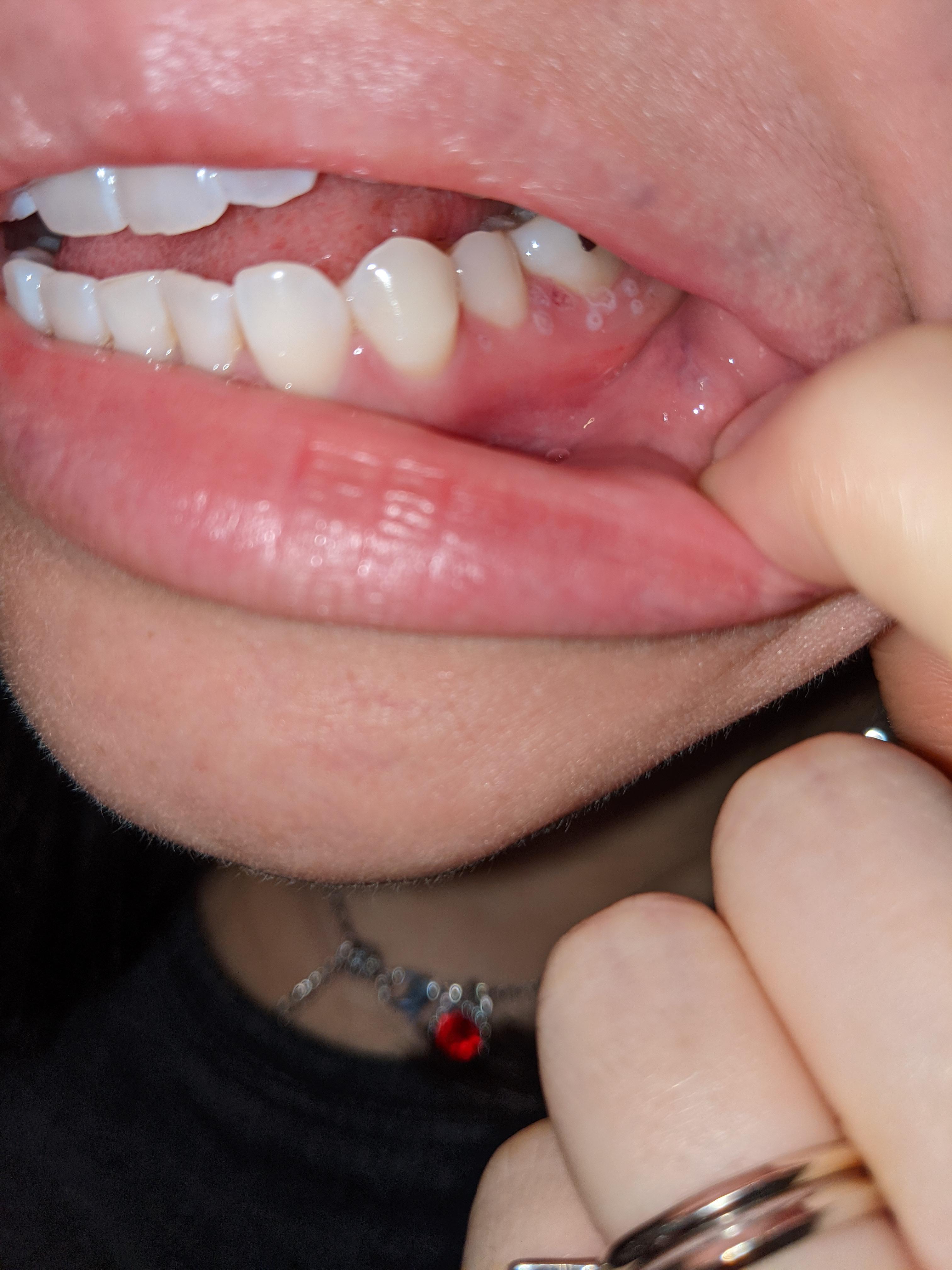 Got my wisdom teeth out 4 days ago. Think they're healing fine but I