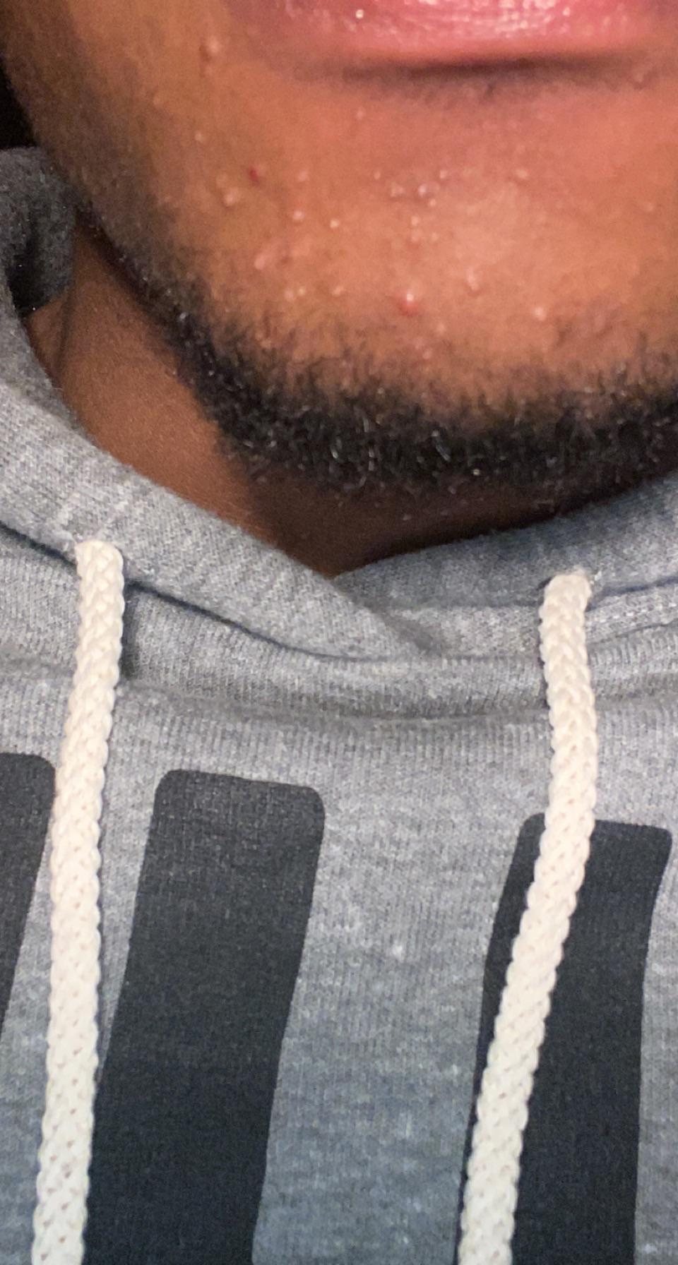 Prednisone acne really bad on chin neck and chest SkincareAddicts