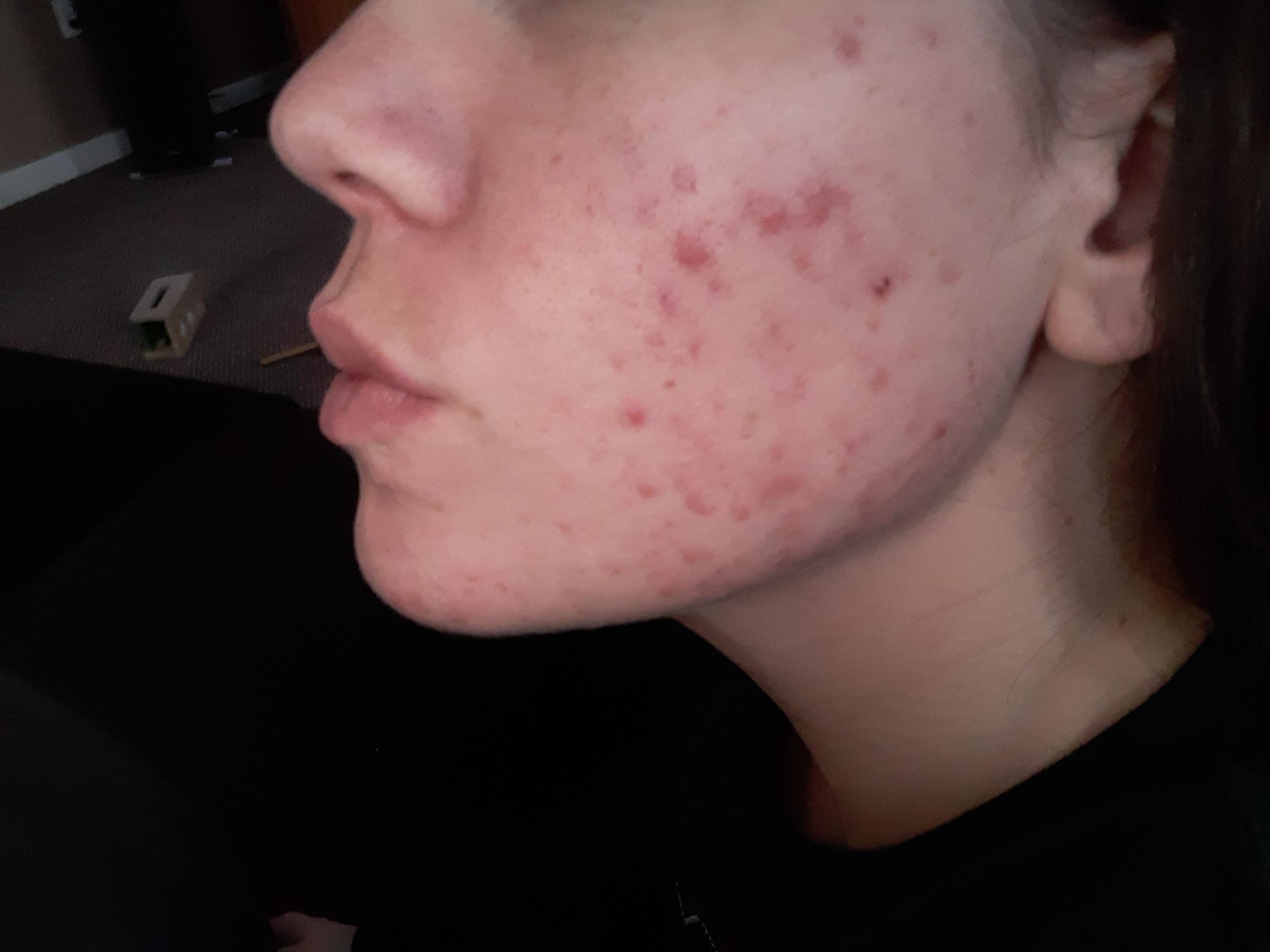 IUD reaction. Never had acne before the iud and now it won't go away