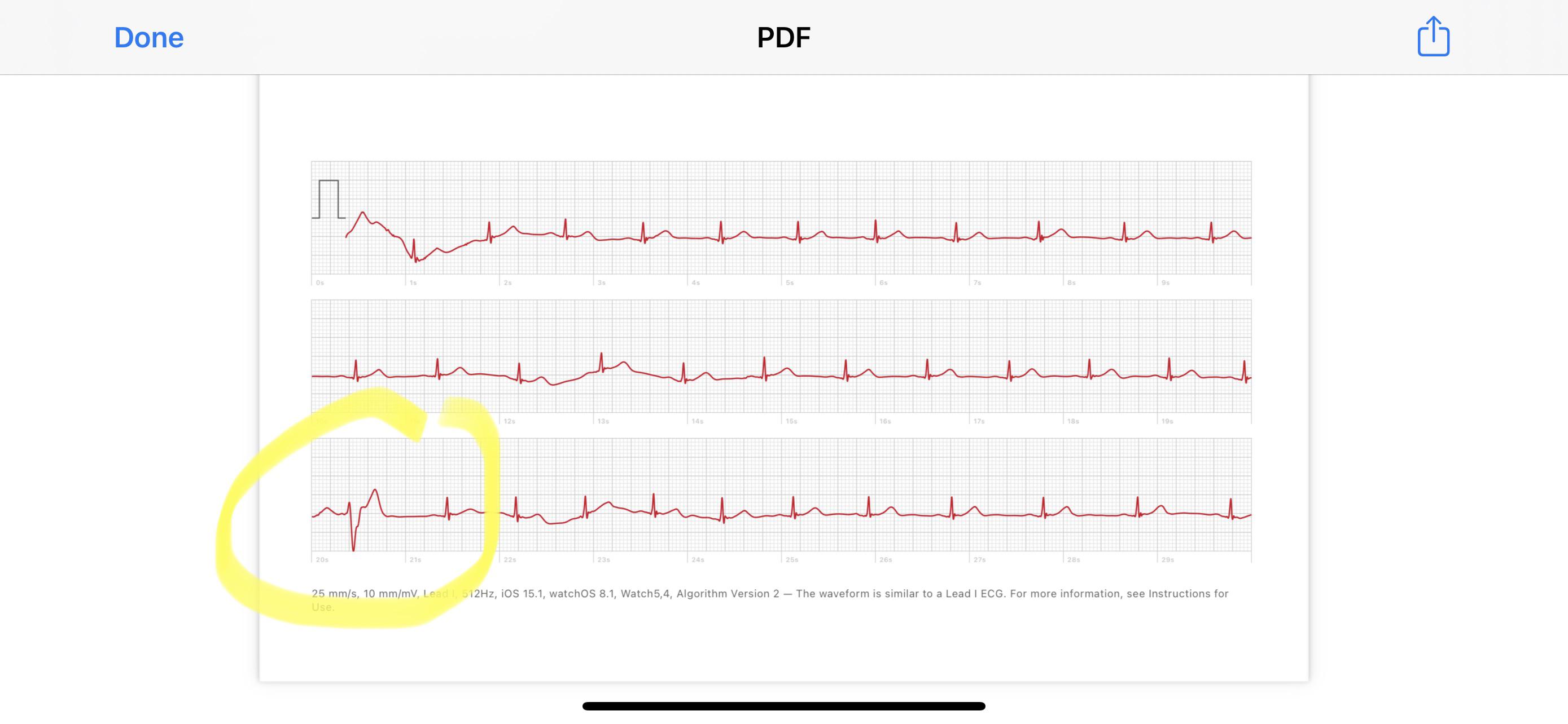 pvc or pac? r/PVCs
