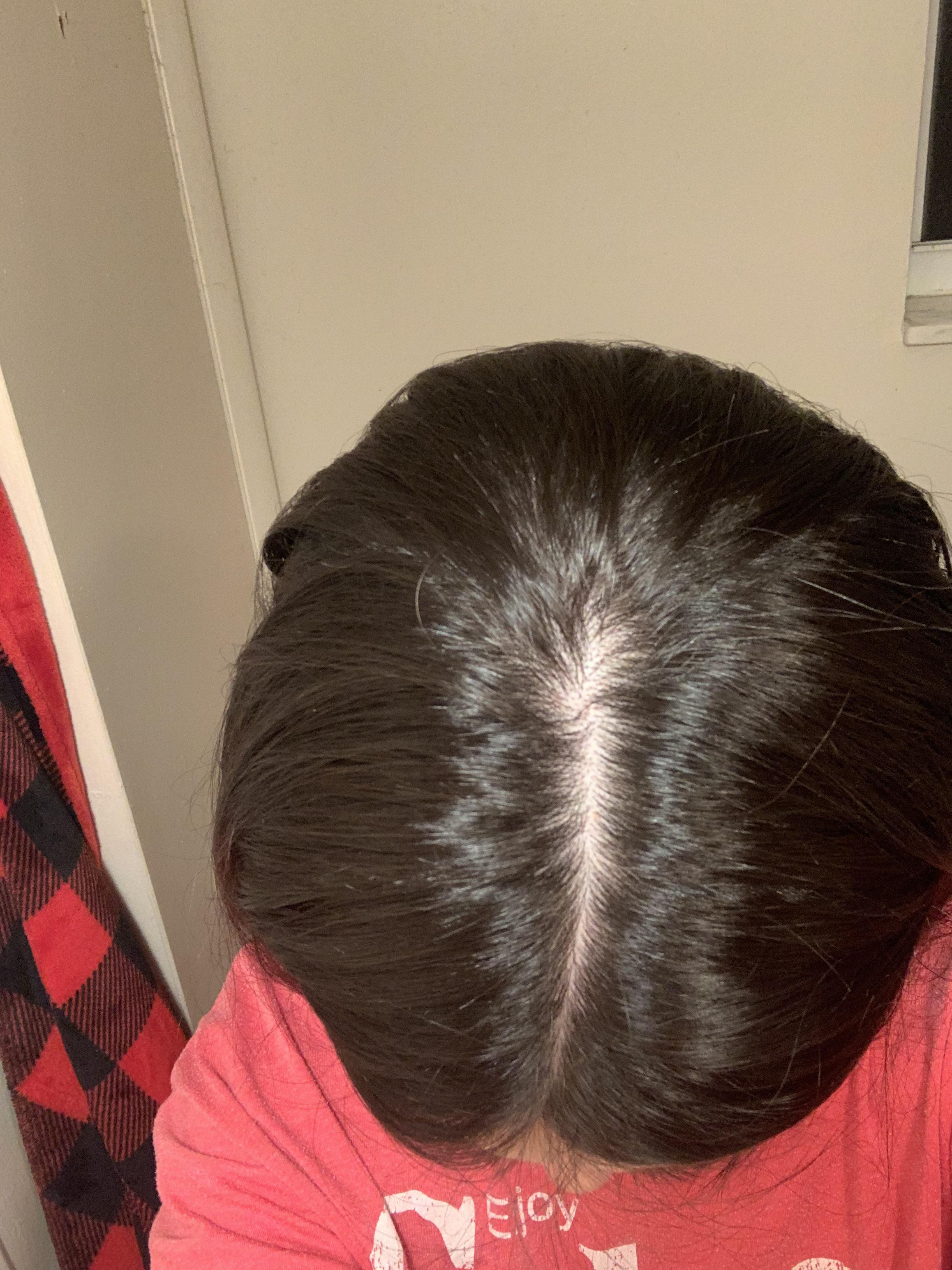 Vellus hairs? Is it normal to have a some on your head? I quit spiro