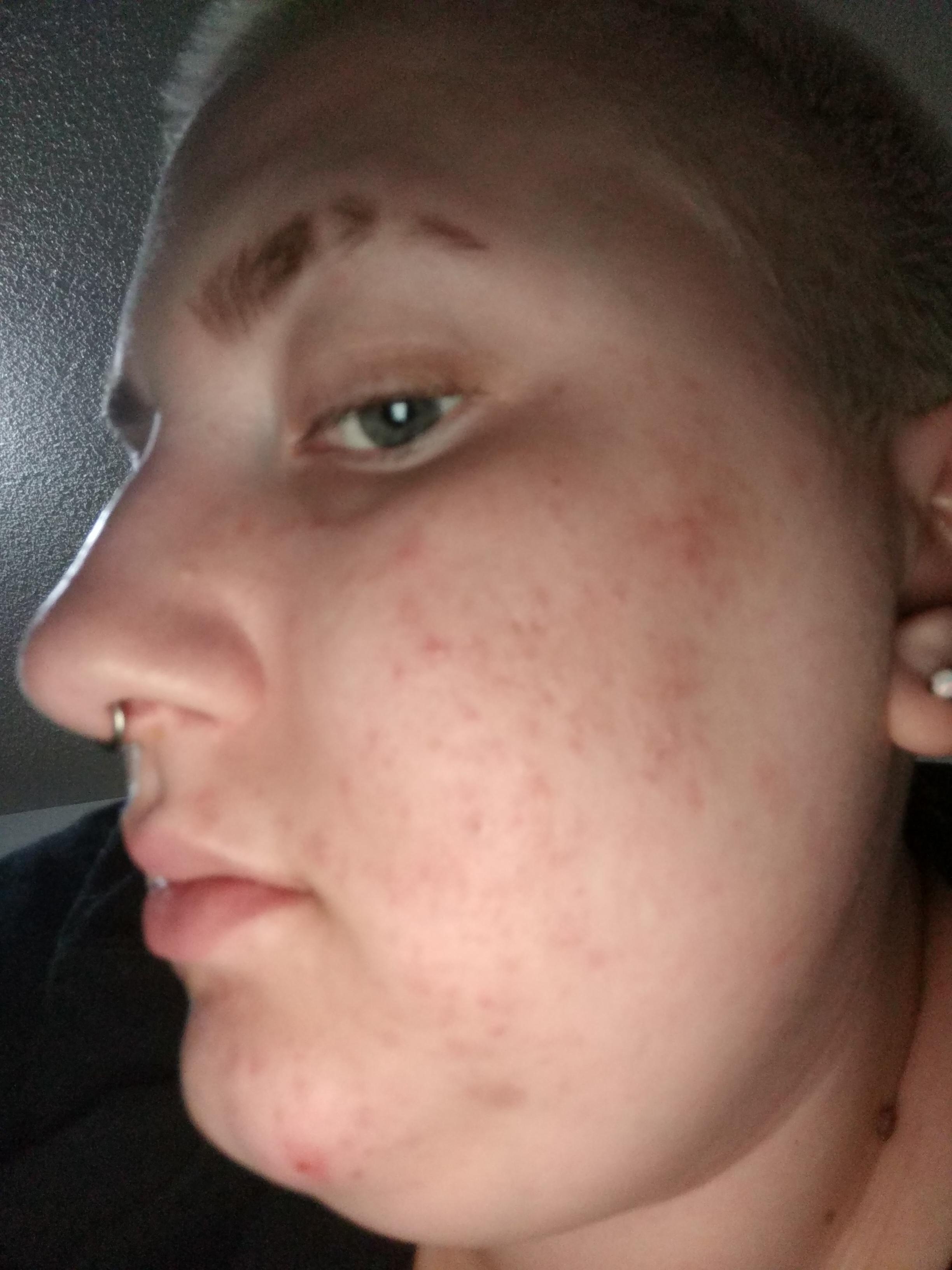 This is a huge red spot(?) on my face, need to get rid of this ASAP 🆘