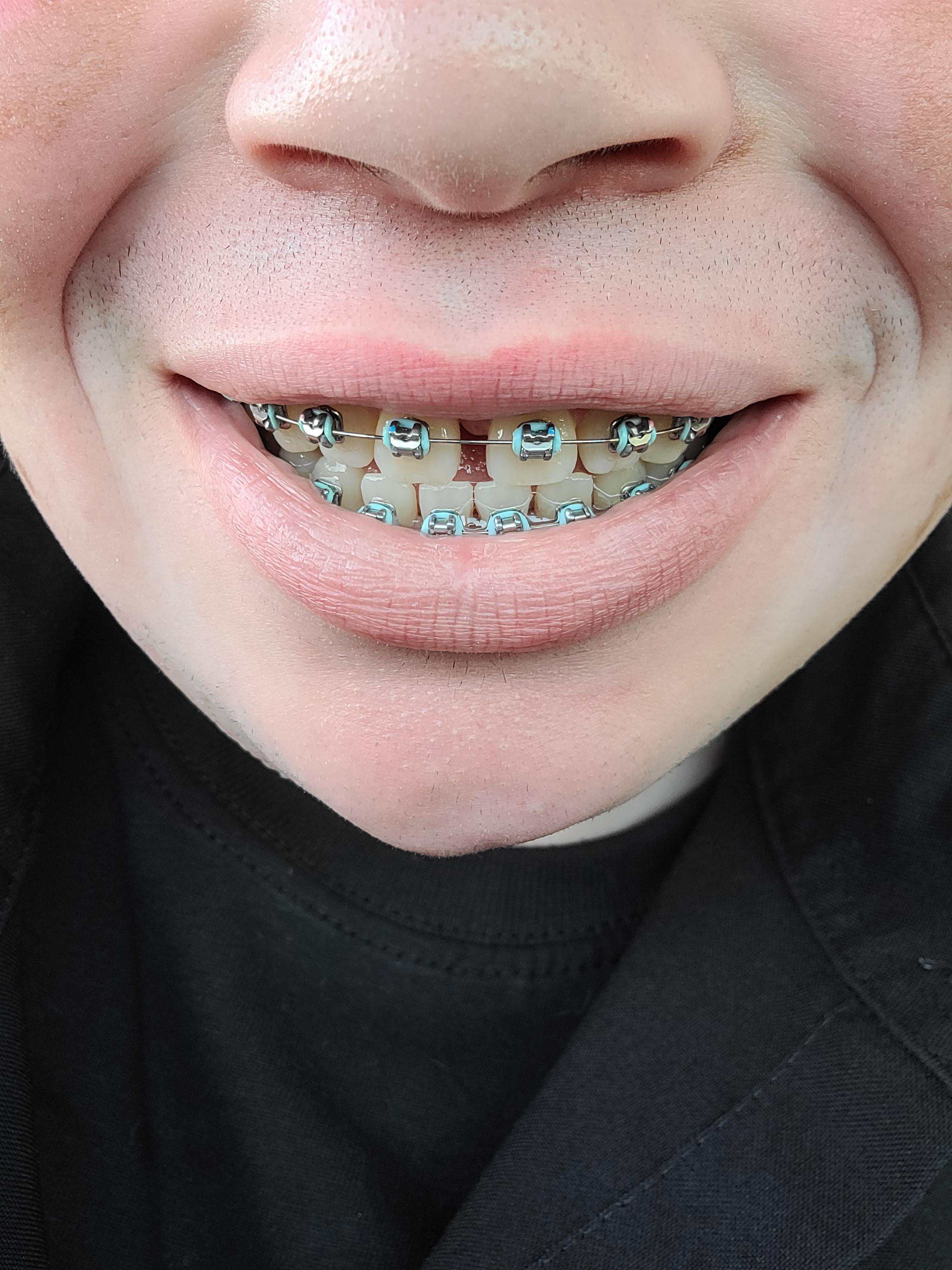 Do You Need Braces Again? Charleston Orthodontic Specialists