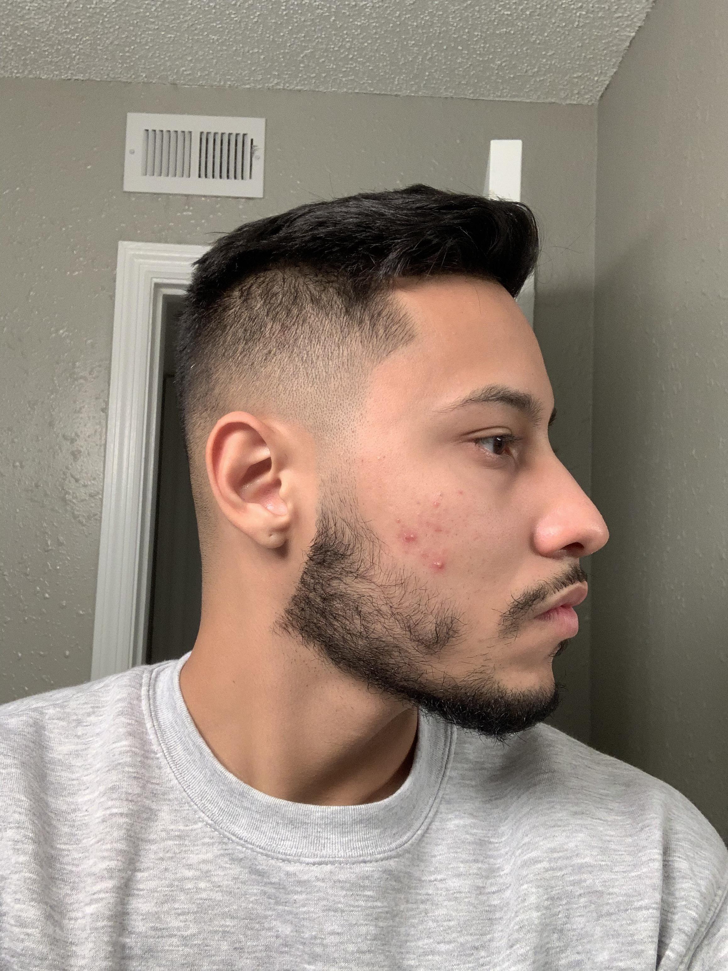 Just curious how can I treat this ? It never goes away and keep coming