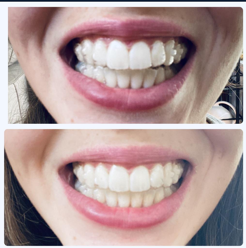 Top is tray 4/16 I had MANY years of braces as a teen and stupidly did