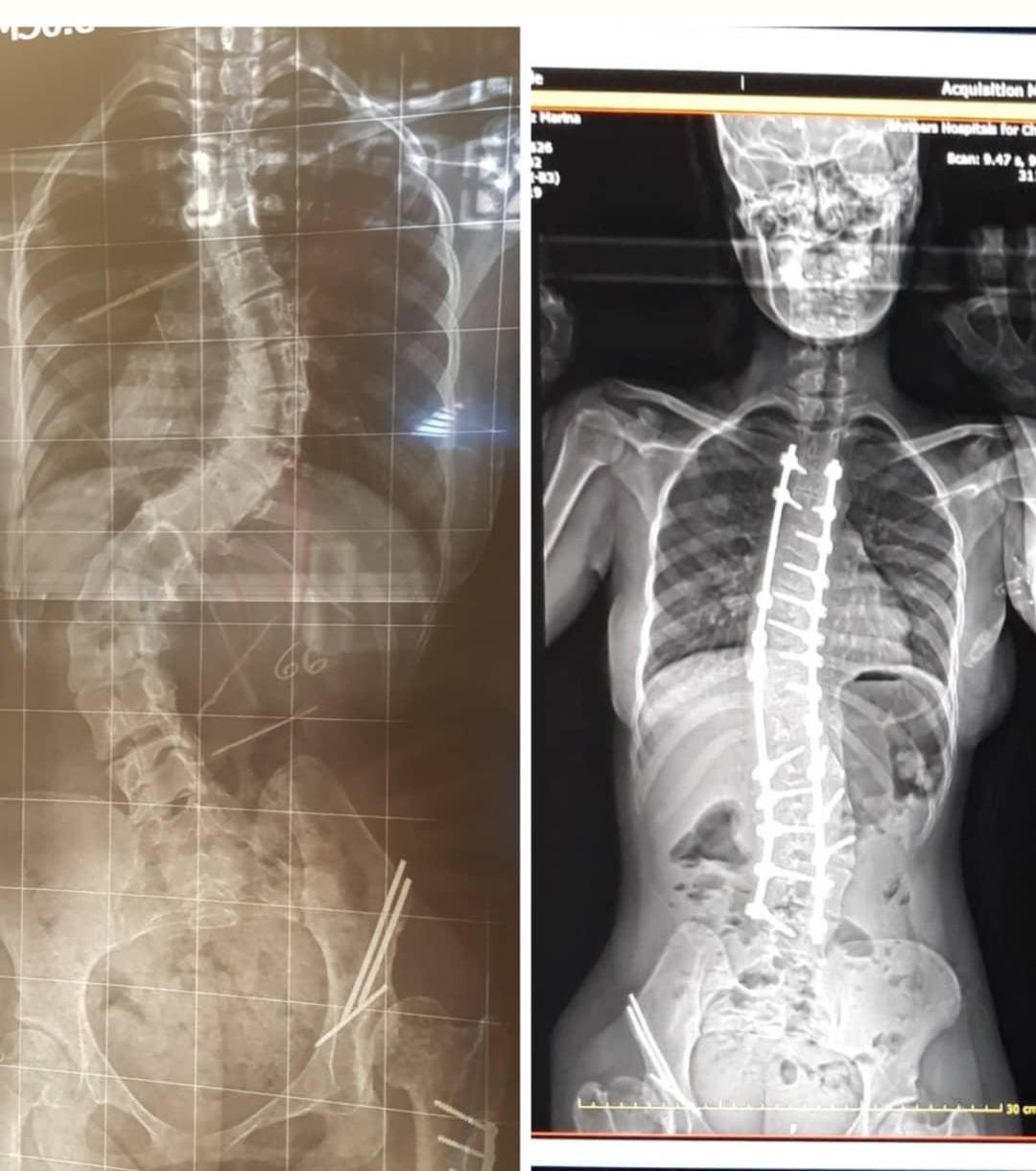 Jobs that won't be painful for scoliosis? r/scoliosis