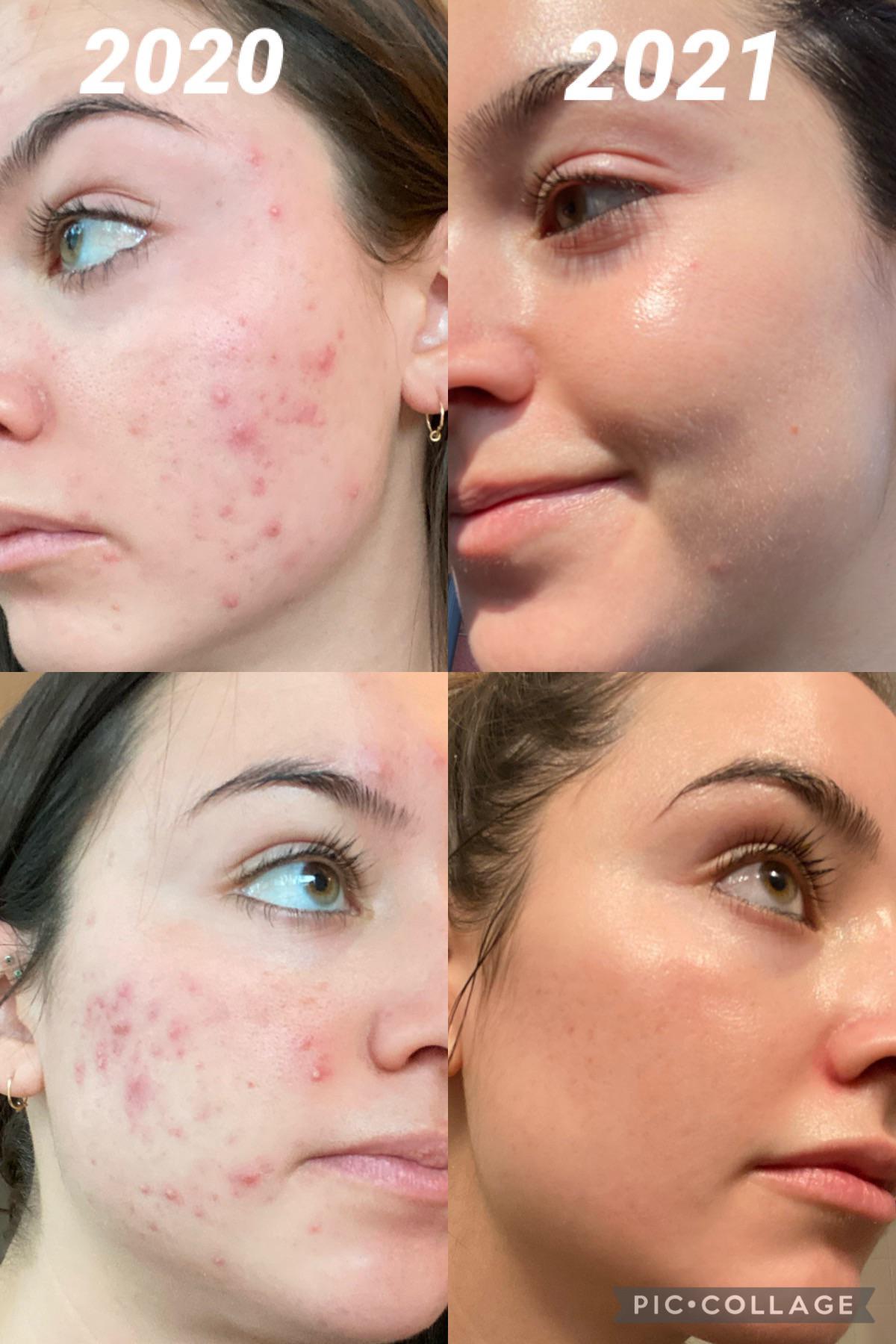 [Before&After] still far from perfect, but one full year of skincare