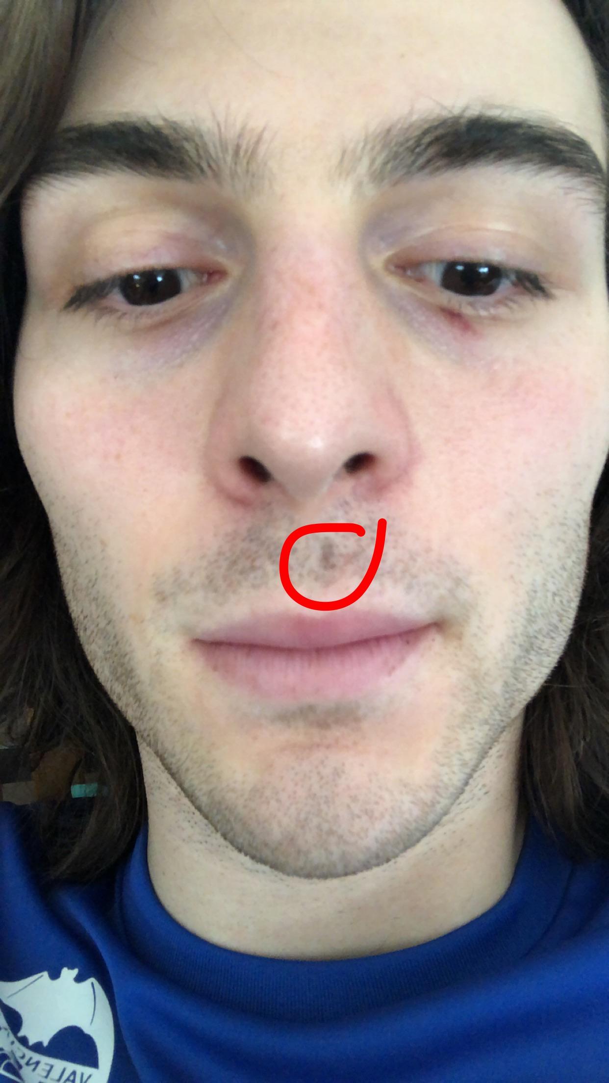 Hi, does anyone know what this dark spot is? I think it’s a bruise from