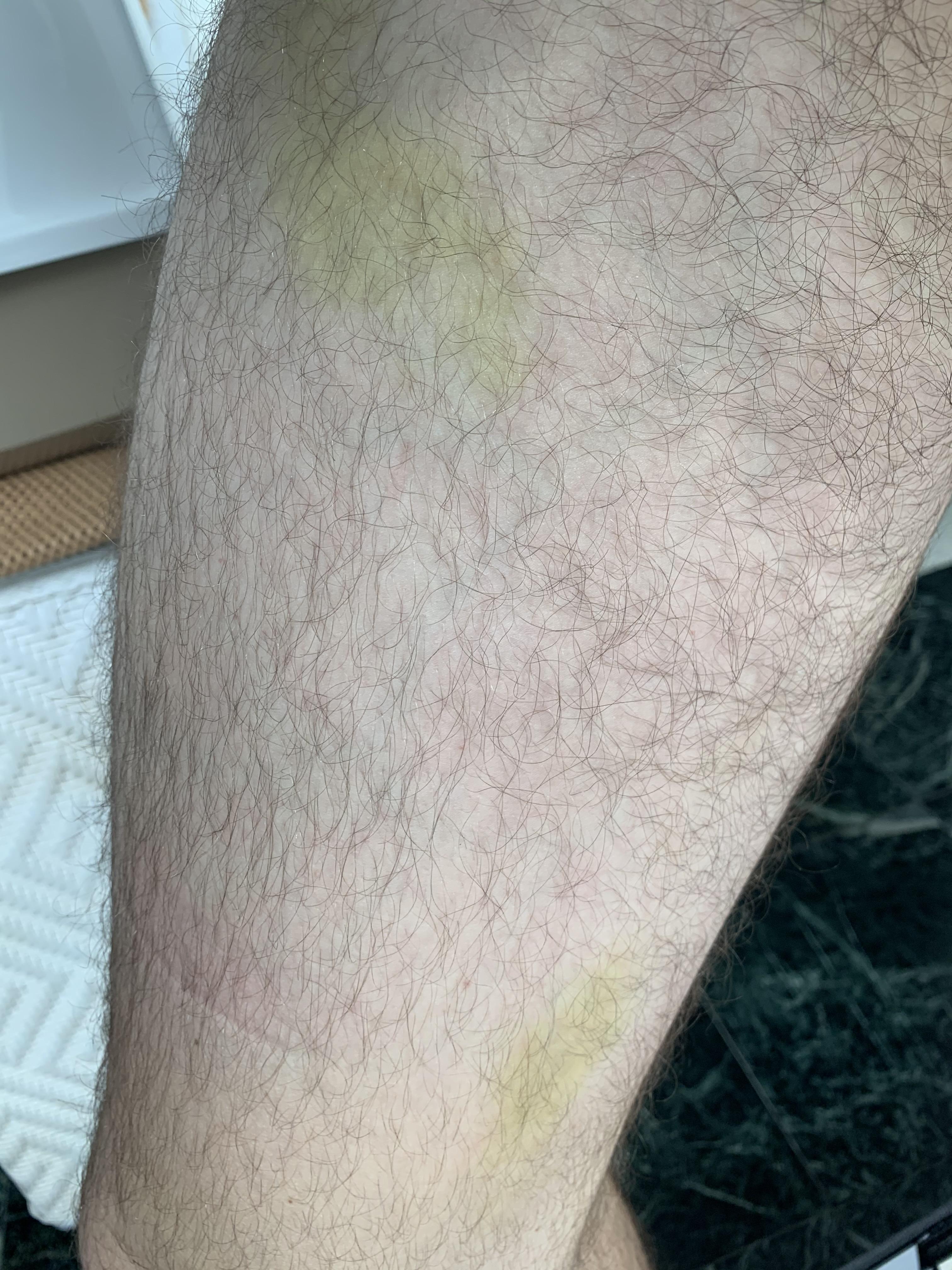 I just noticed these yellow marks on my leg and I have no idea what