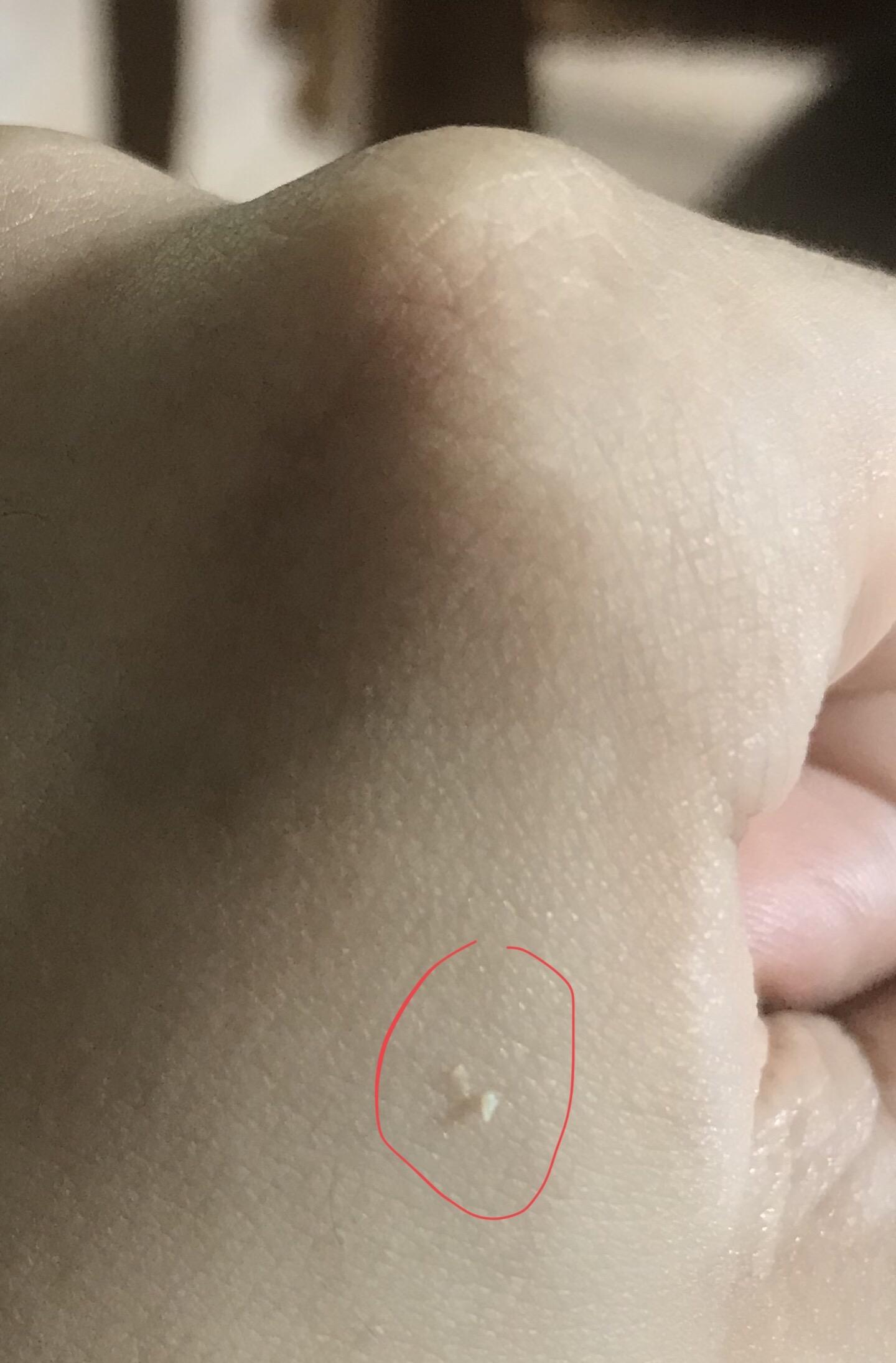 Keratin Plug Vs Sebum Plug 2foundationsacneiform Flashcards Quizlet