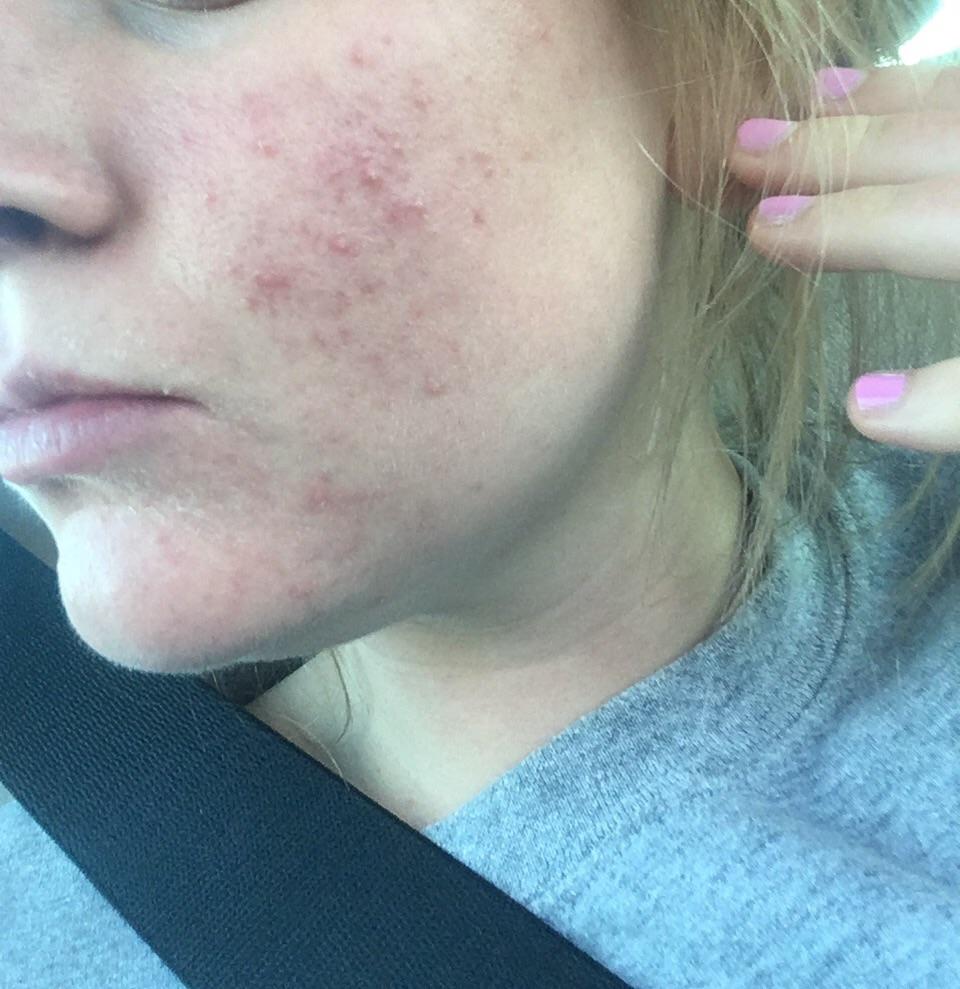 [acne] is this just my skin purging from Differin? Three weeks now using Differin r