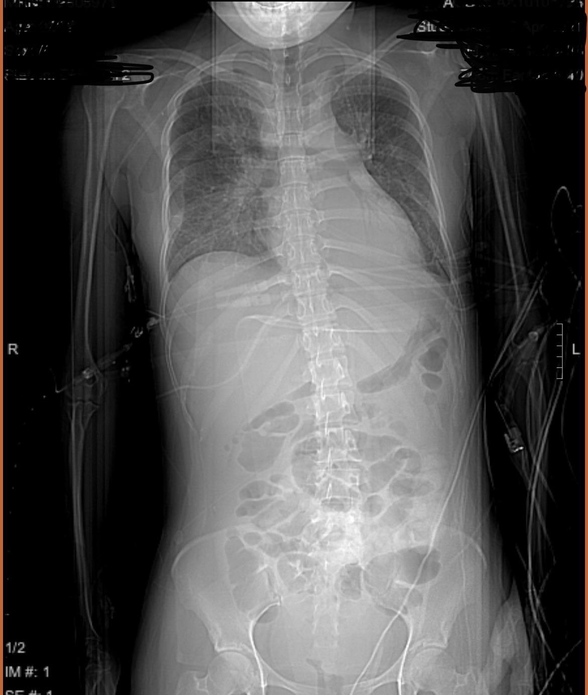 Mild scoliosis causing lateral pelvic tilt to the right? r/scoliosis