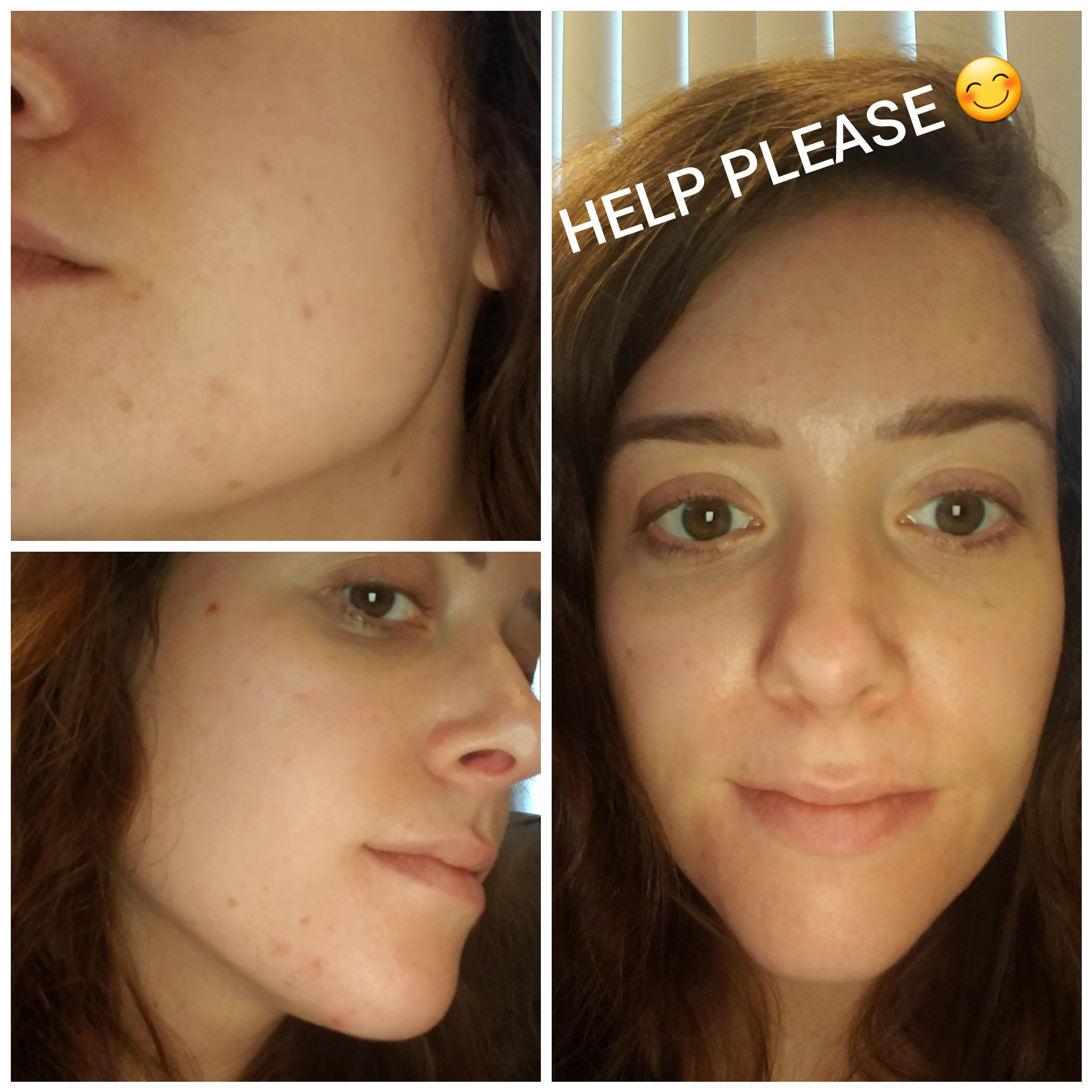 [Routine Help] Acne Gets Better After High School & Other Lies Tales