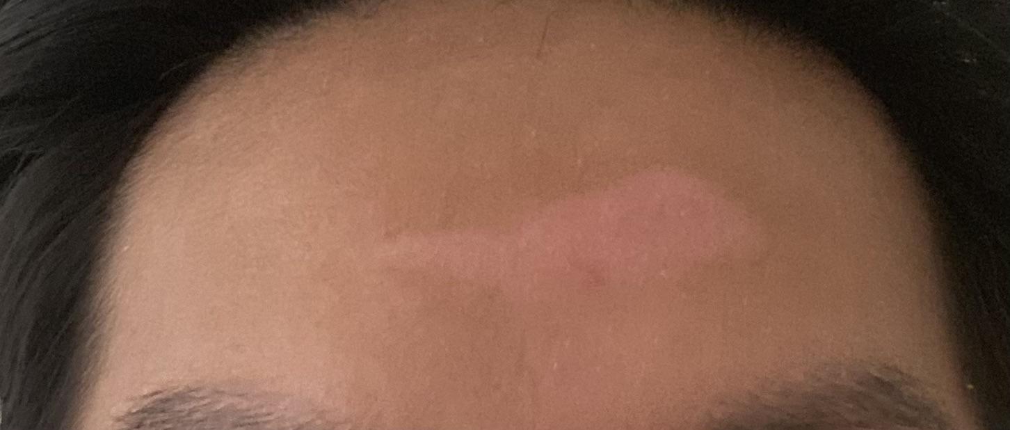 Help with pink scar healing [skin concerns] r/SkincareAddiction