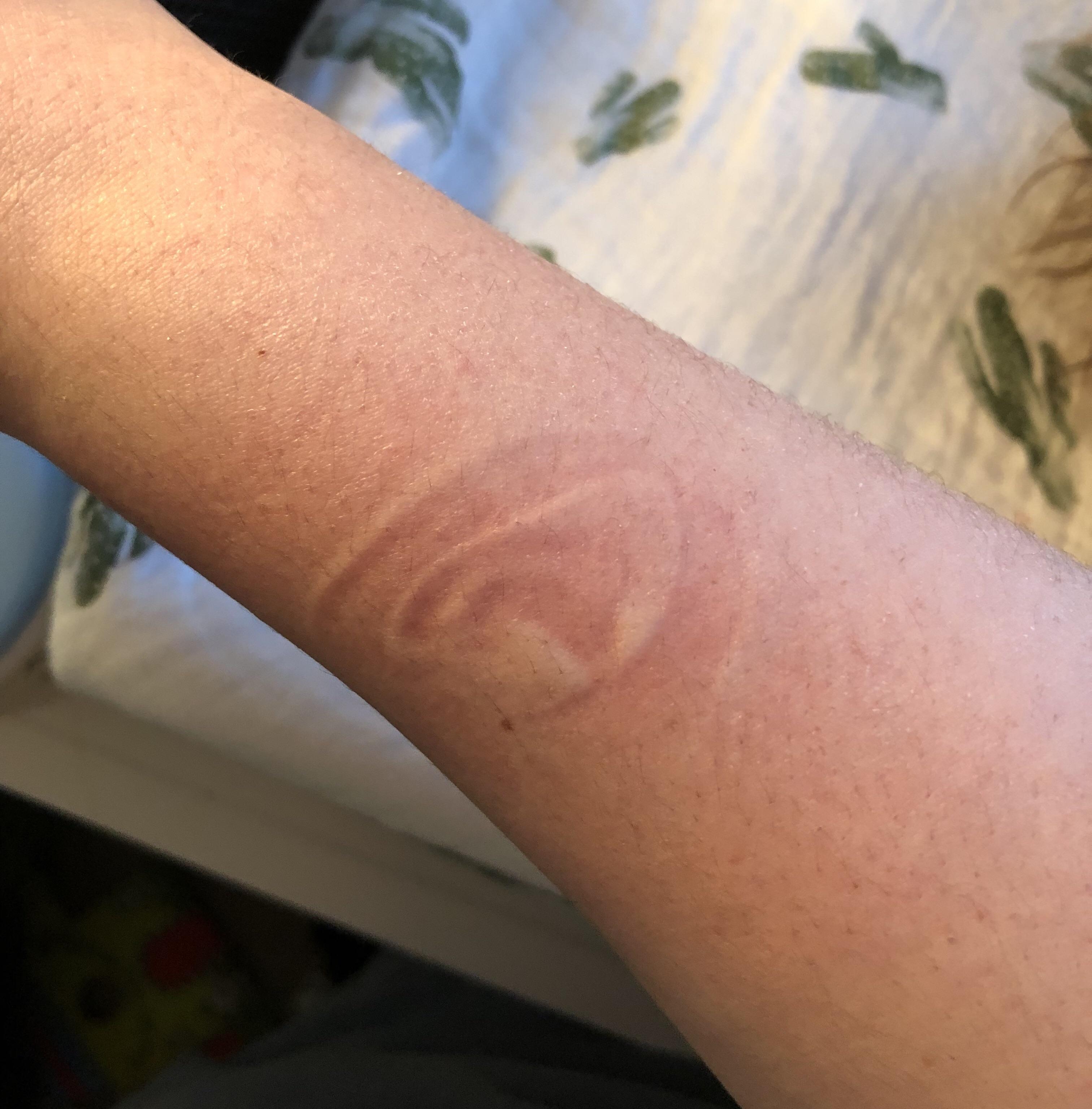 My baby napped in my arms and his ear left an imprint on my arm r
