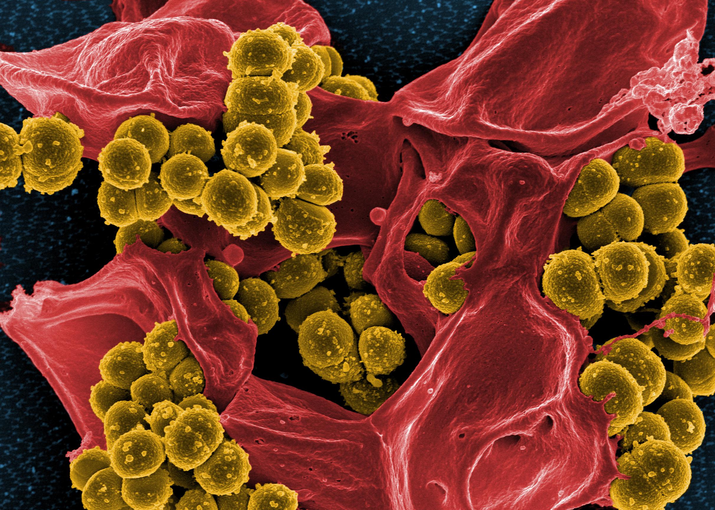 TIL First confirmed MRSA (methicillinresistant Staphylococcus aureus