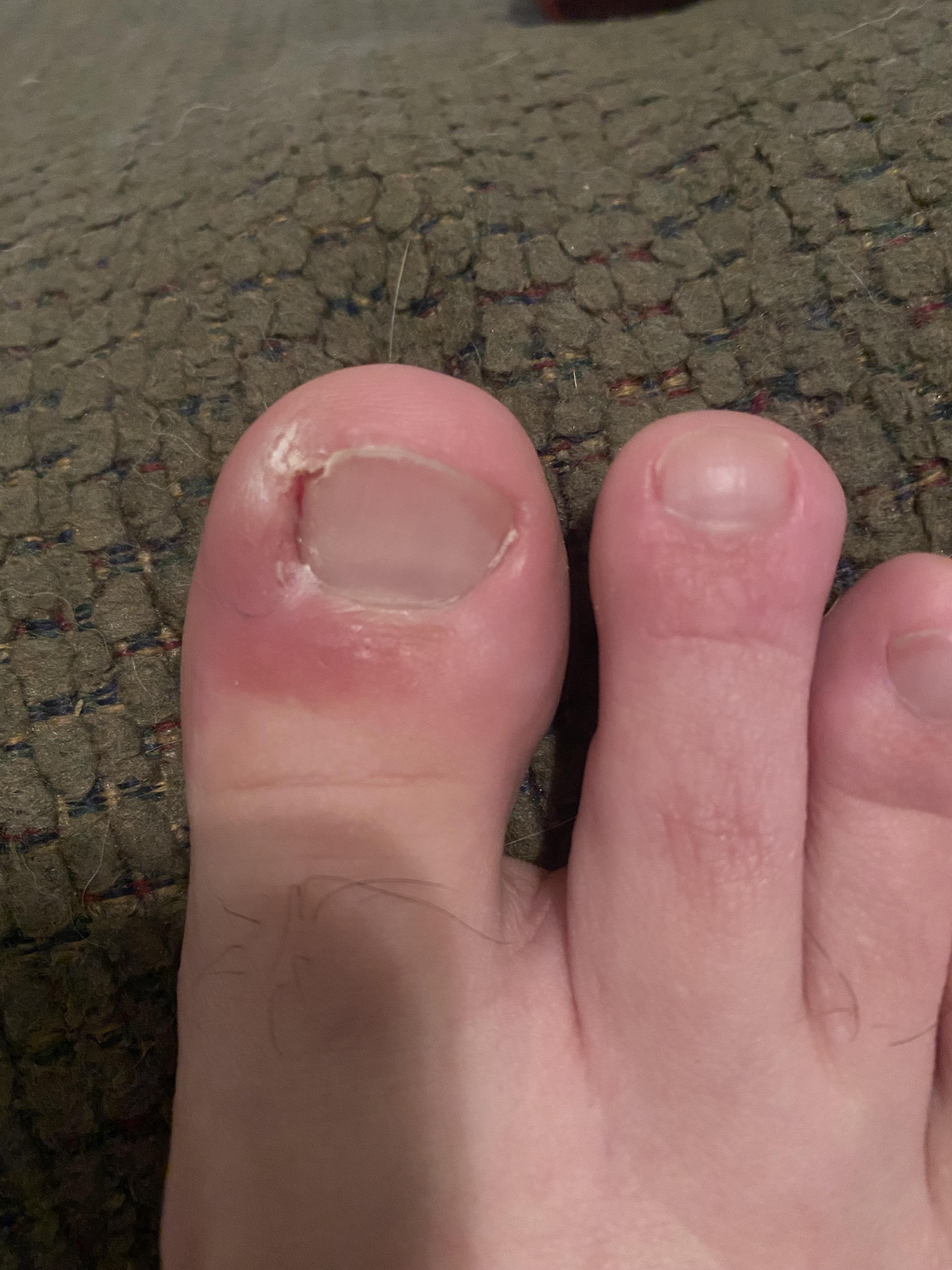 Do I have an ingrown or impacted toenail? r/Ingrown_Toenails
