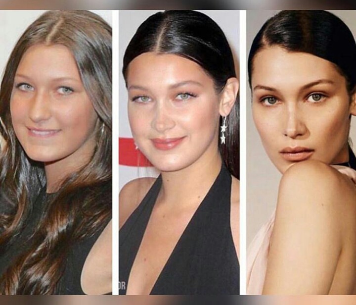 Bella Hadid AtoZplasticsurgery