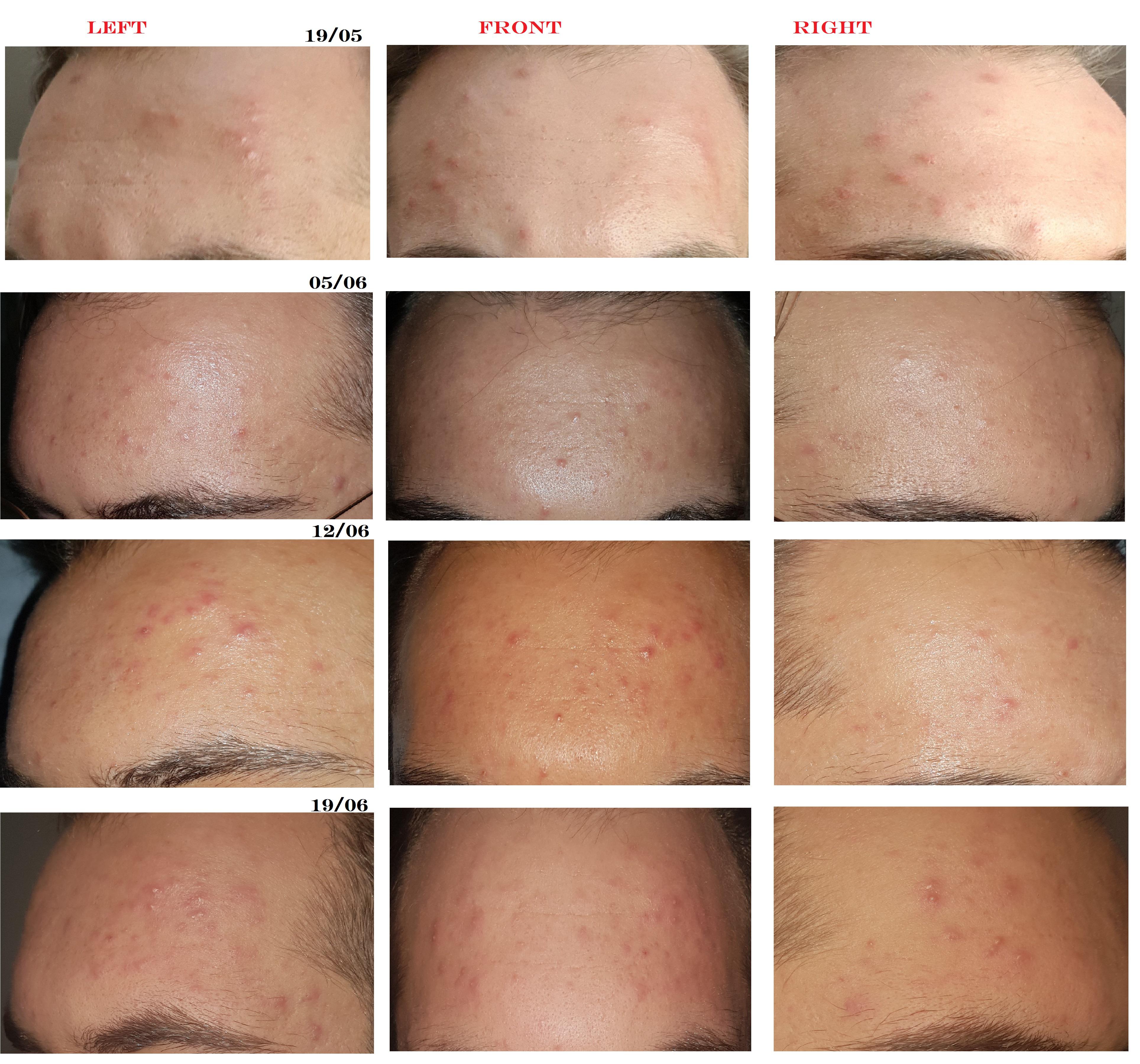 [ACNE] Please help! Breakout caused by hair products details in