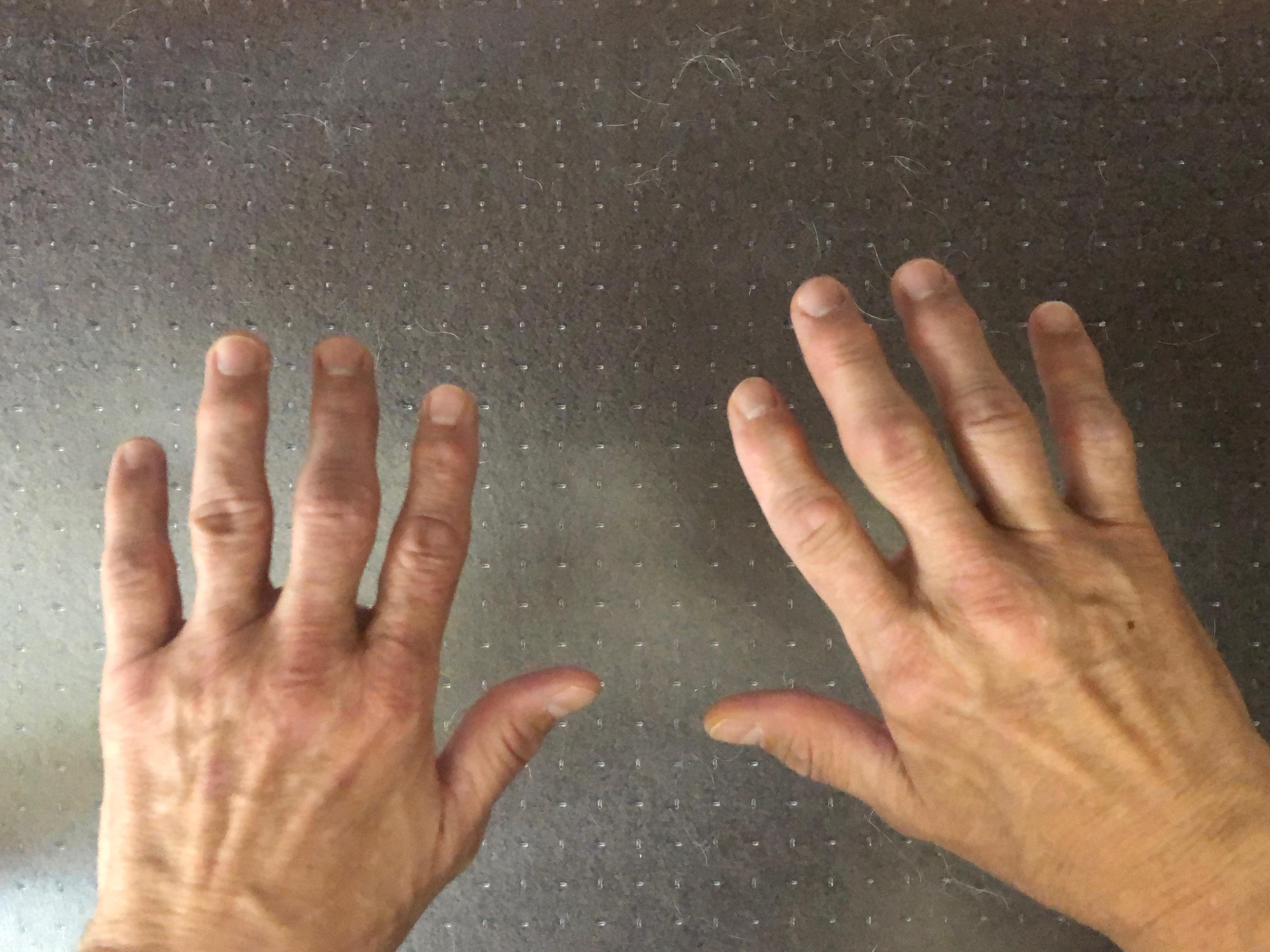 This is what my hands look after 14 years of JiuJitsu. Anyone else