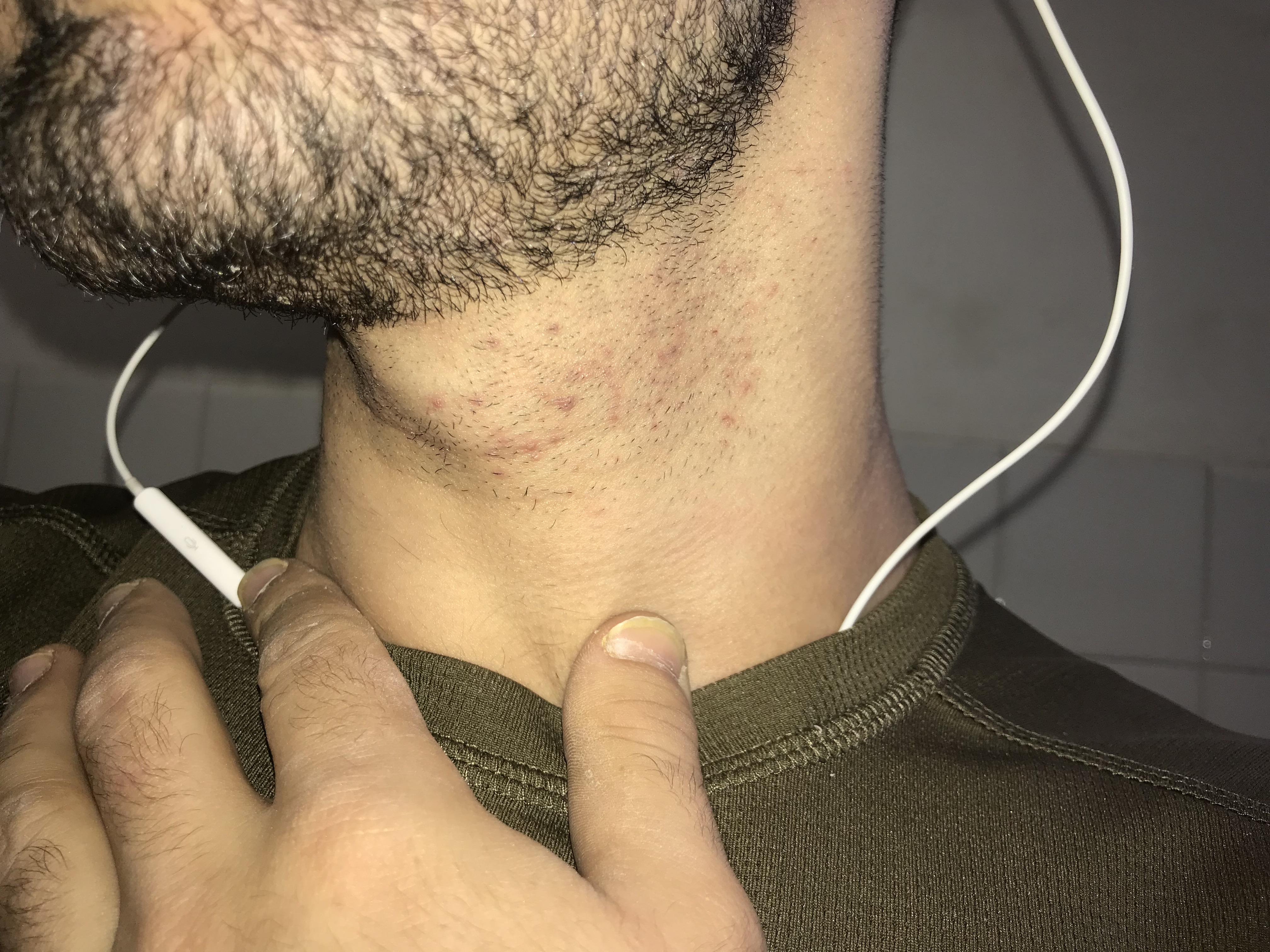 How i can prevent this ingrown/irritation hair on my neck ? r/wicked_edge