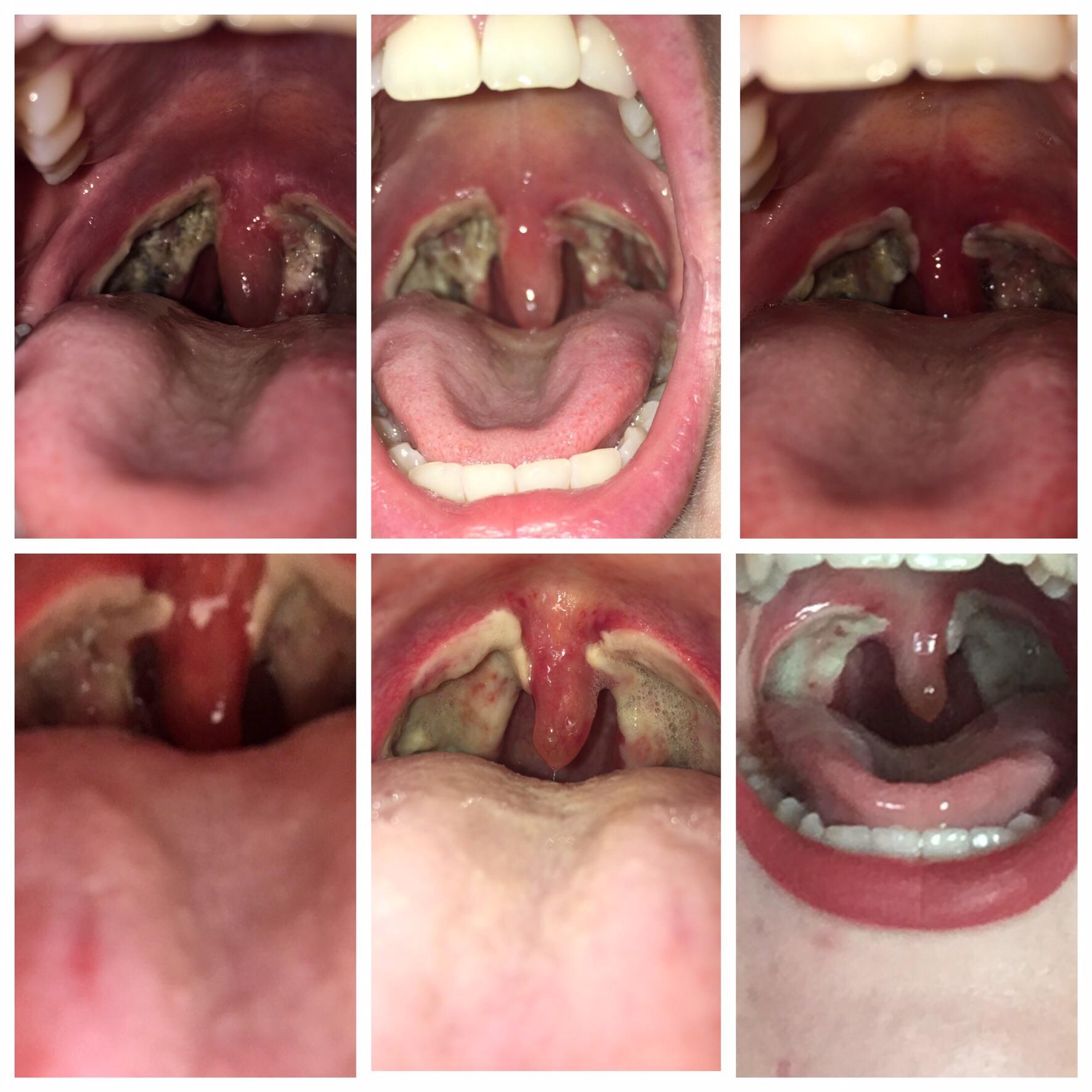 Tonsil removal healing timeline. popping