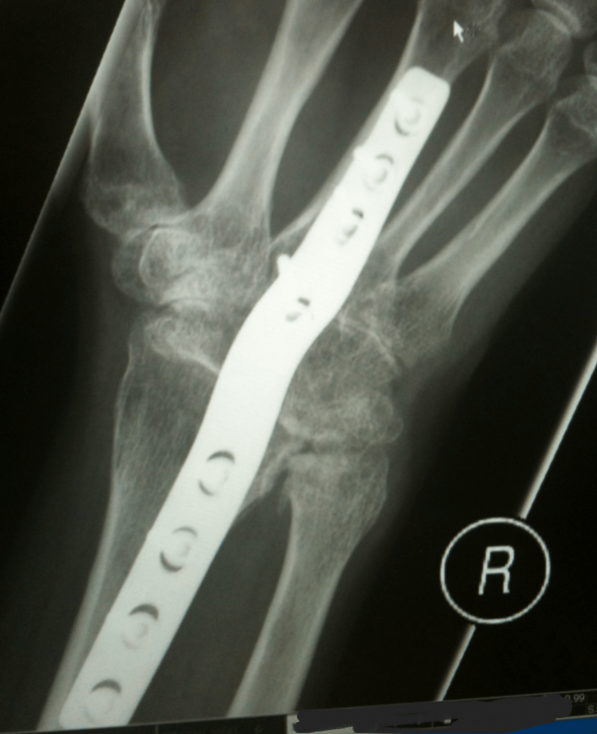 Psoriatic arthritis ate my wrist & carpal joints (Part 6). 4 months