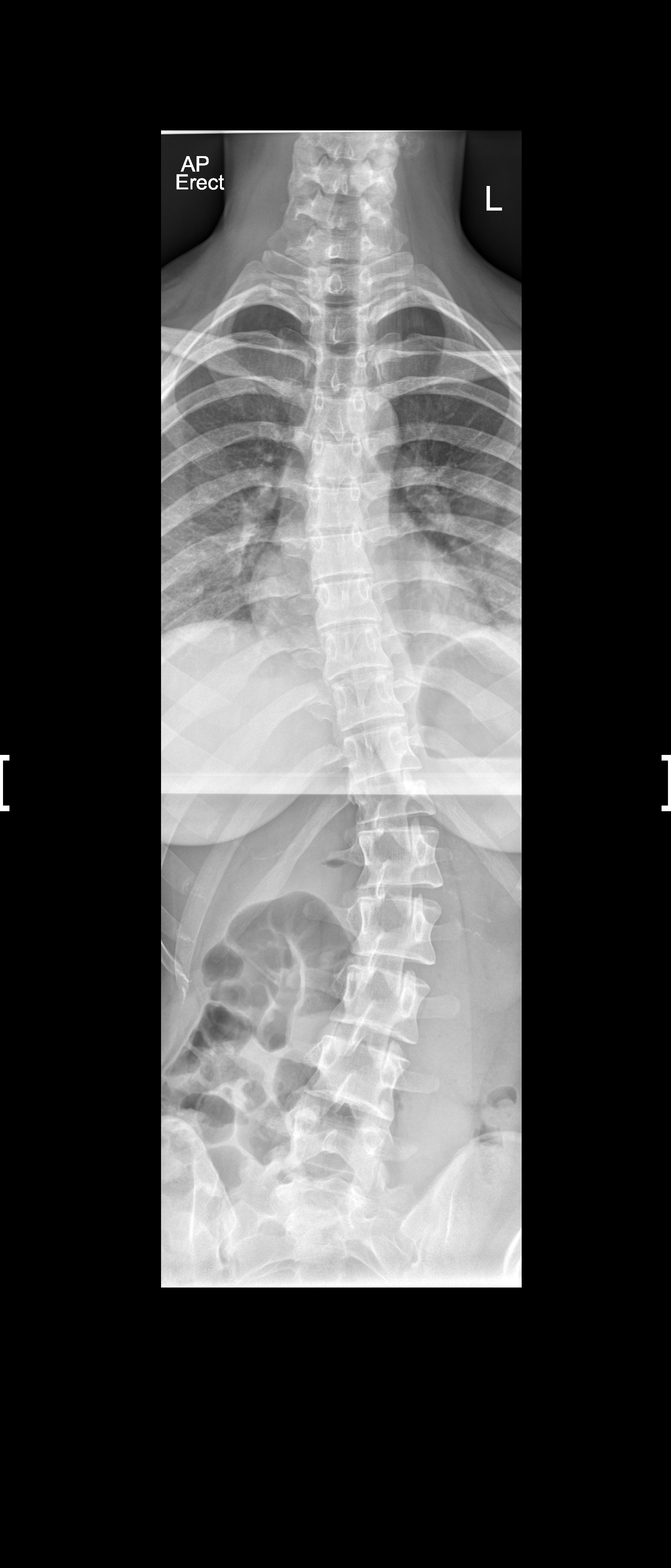 What do I do? I’m 18 and I have severe scoliosis. I live in the