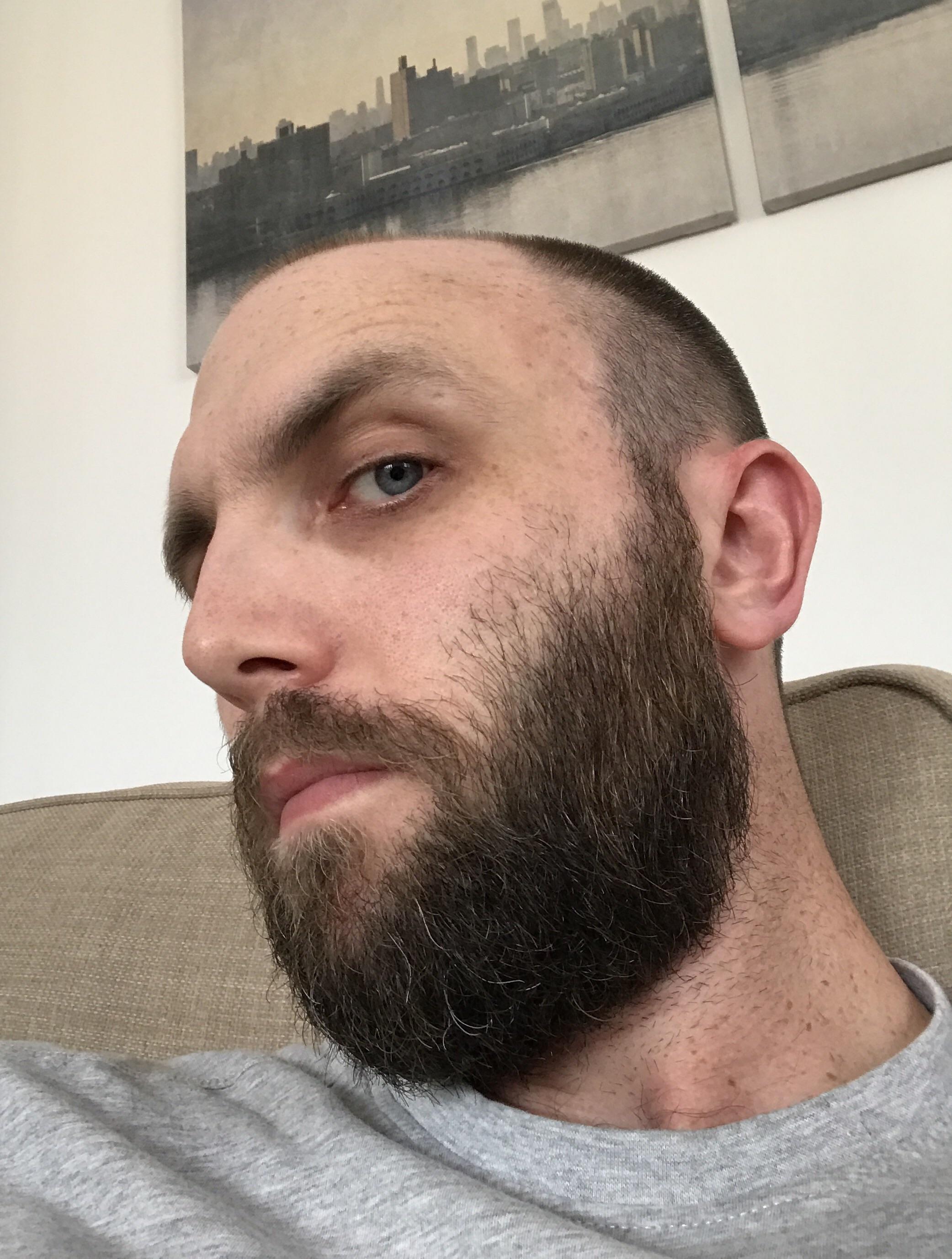 2 months today. Decided to leave the cheek lines for a while and see