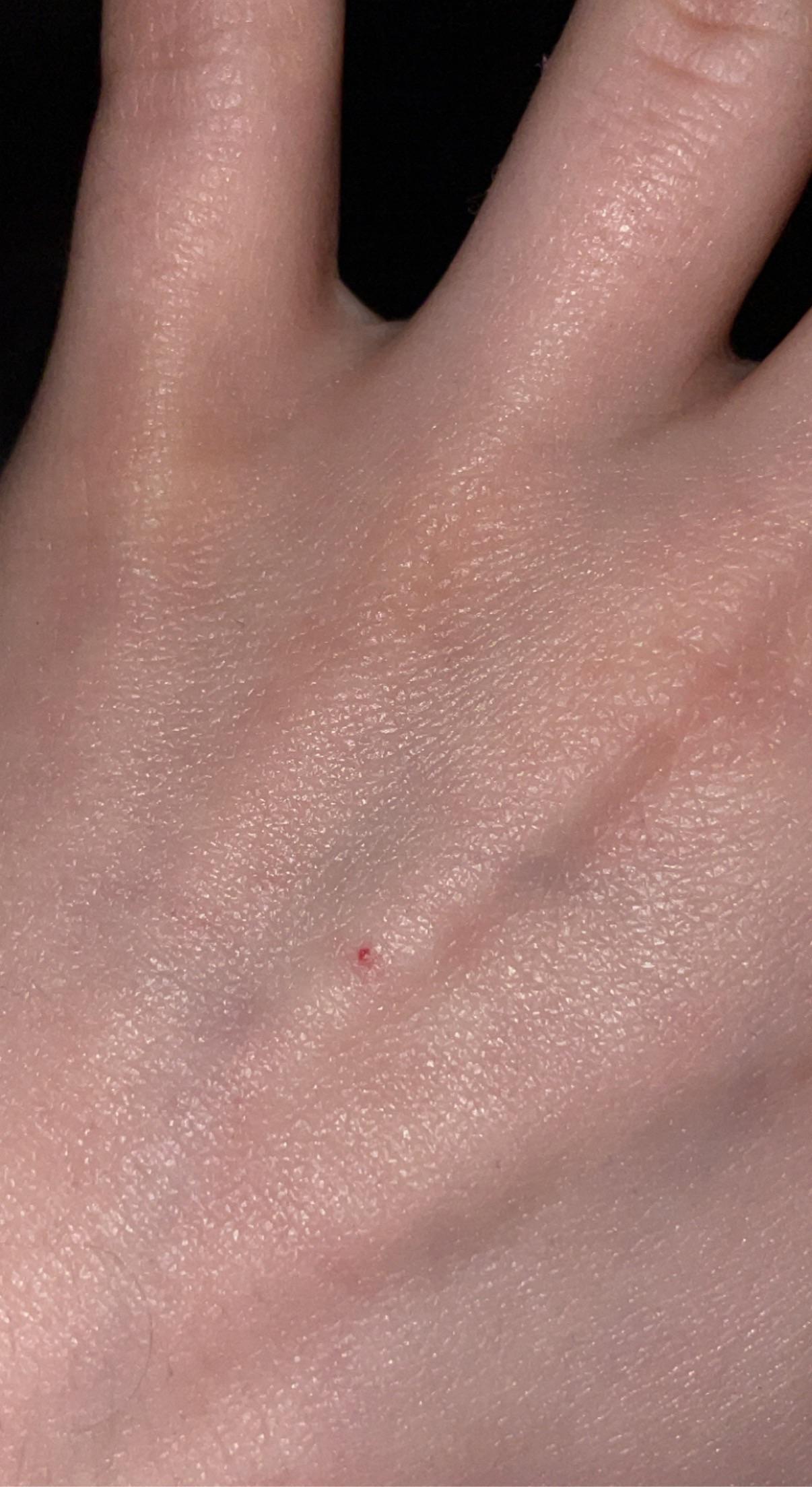 Petechiae or cherry angioma?? I’ve had it for about three or four