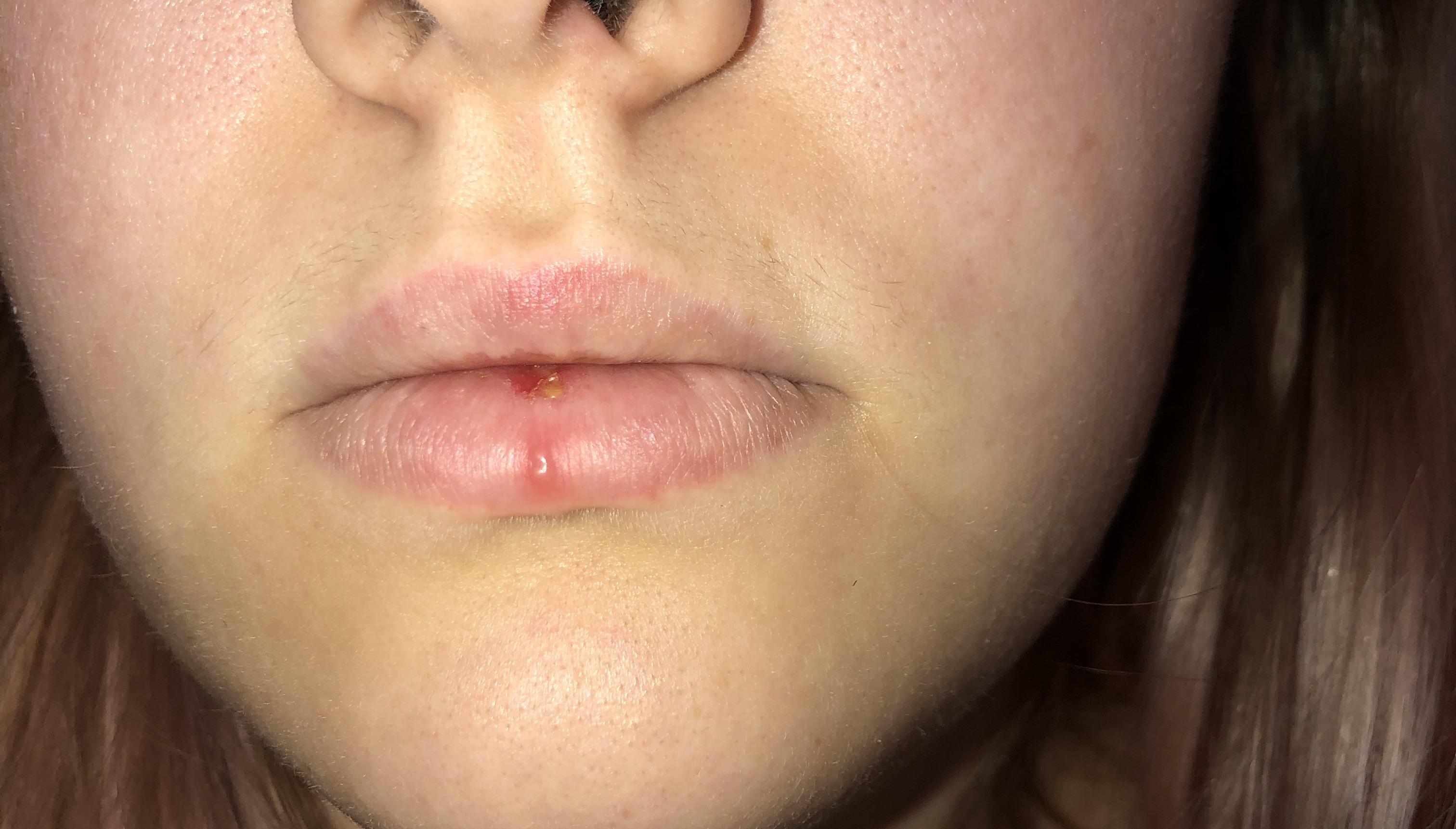 WHAT THE HELL.. I’ve had this sore on my lips for probably almost a