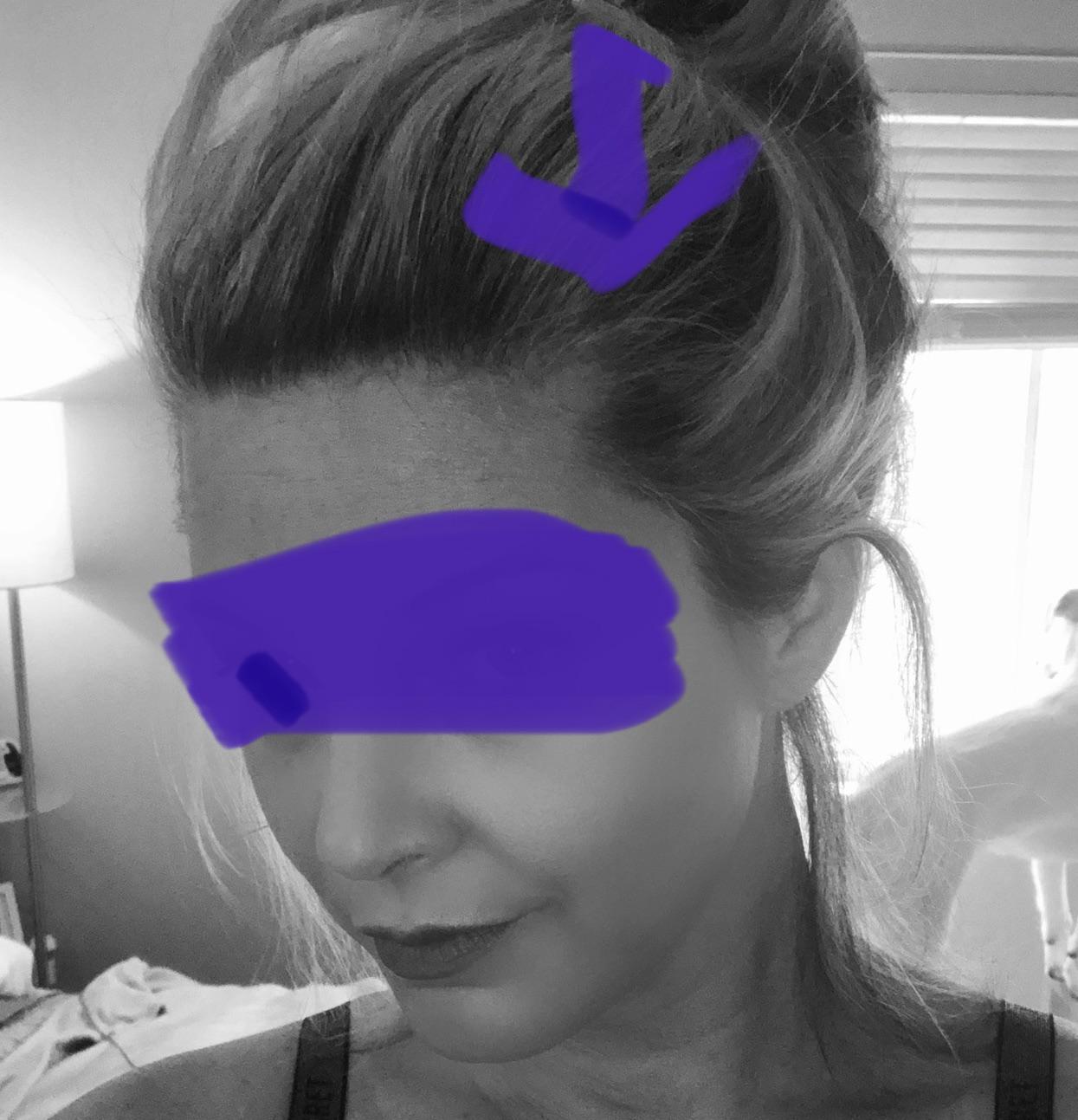 Spiro and weight loss? Spironolactone