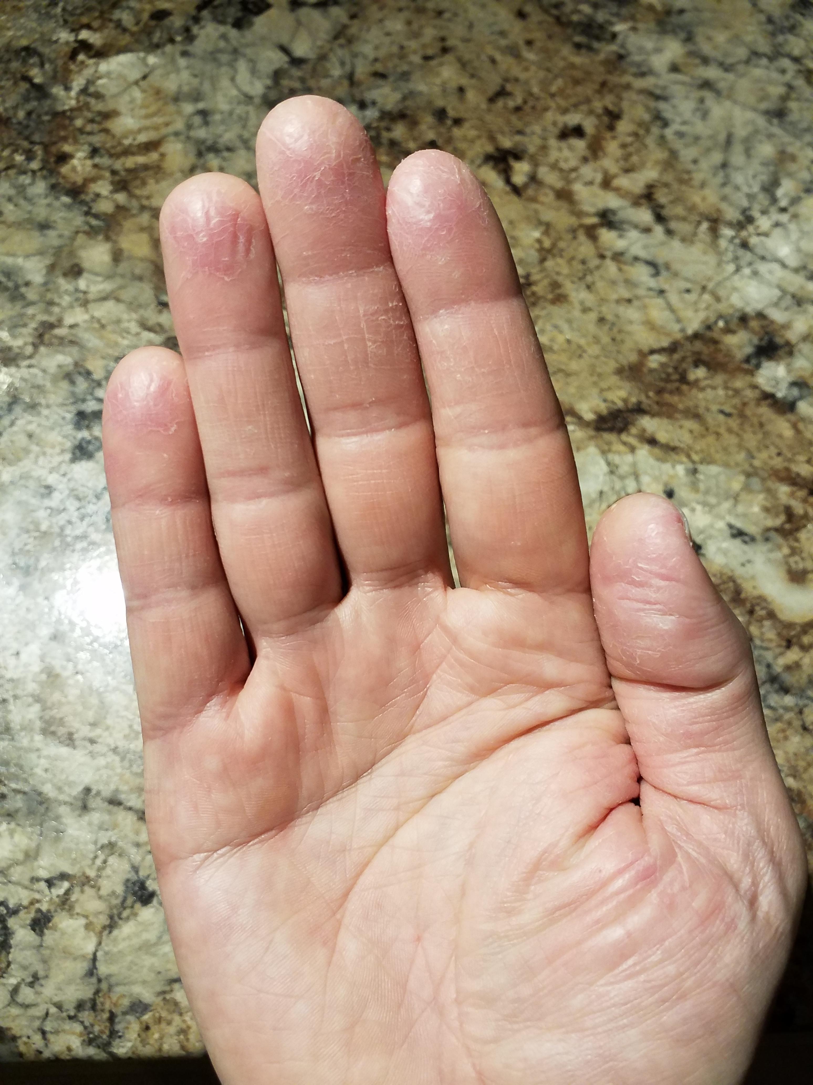 Benefit of Hand Eczema Having fun with border agents as they try to