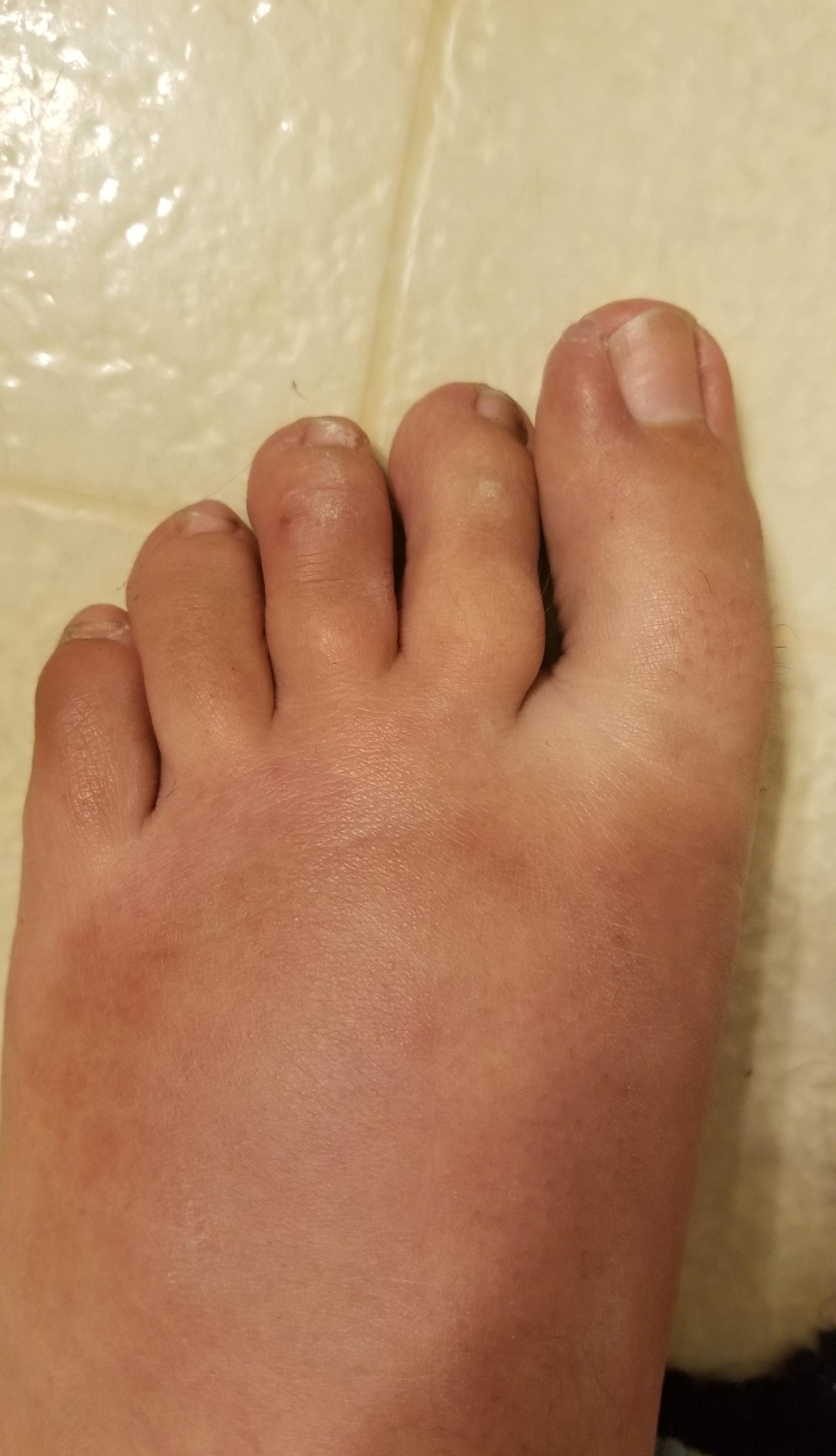 Athletes foot, wasp sting, or somehing else? r/Dermatology