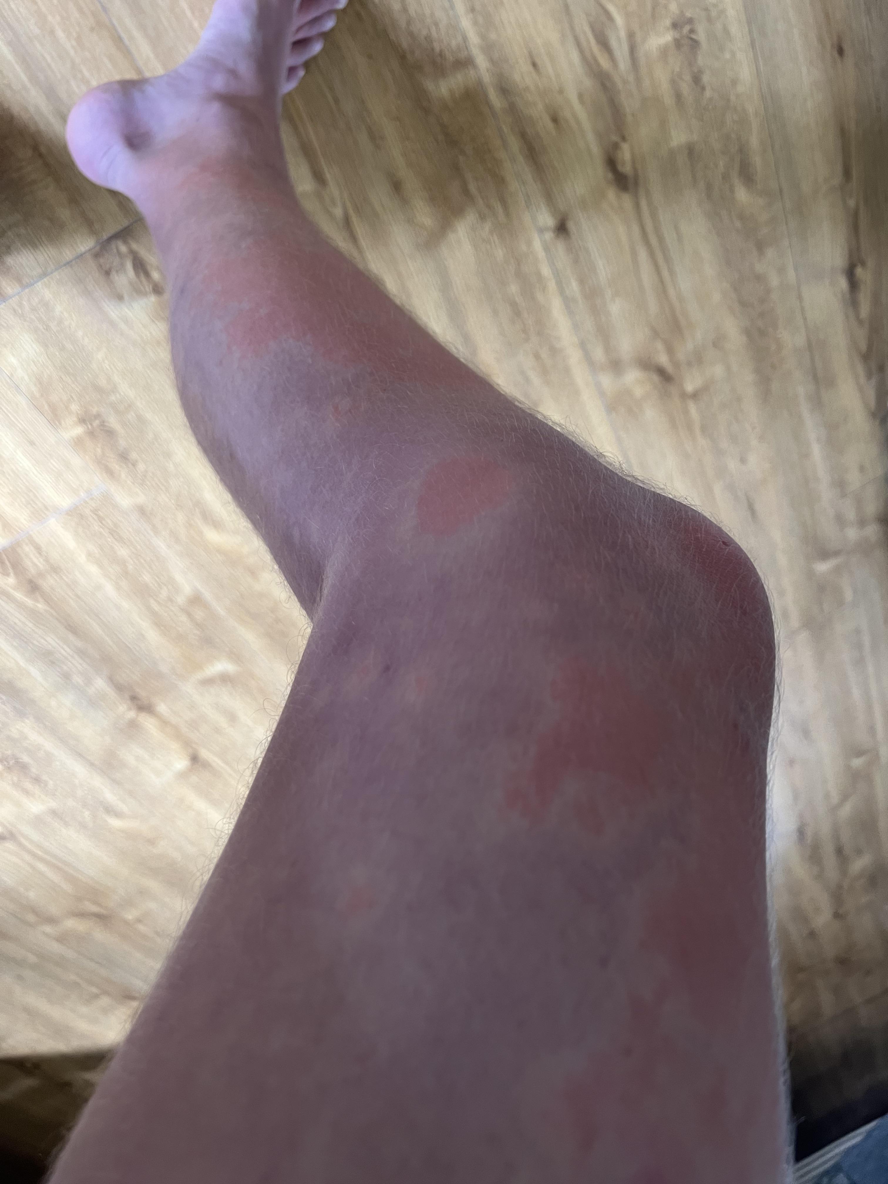 Legs turn purple & red after shower does anyone know why? r/DiagnoseMe