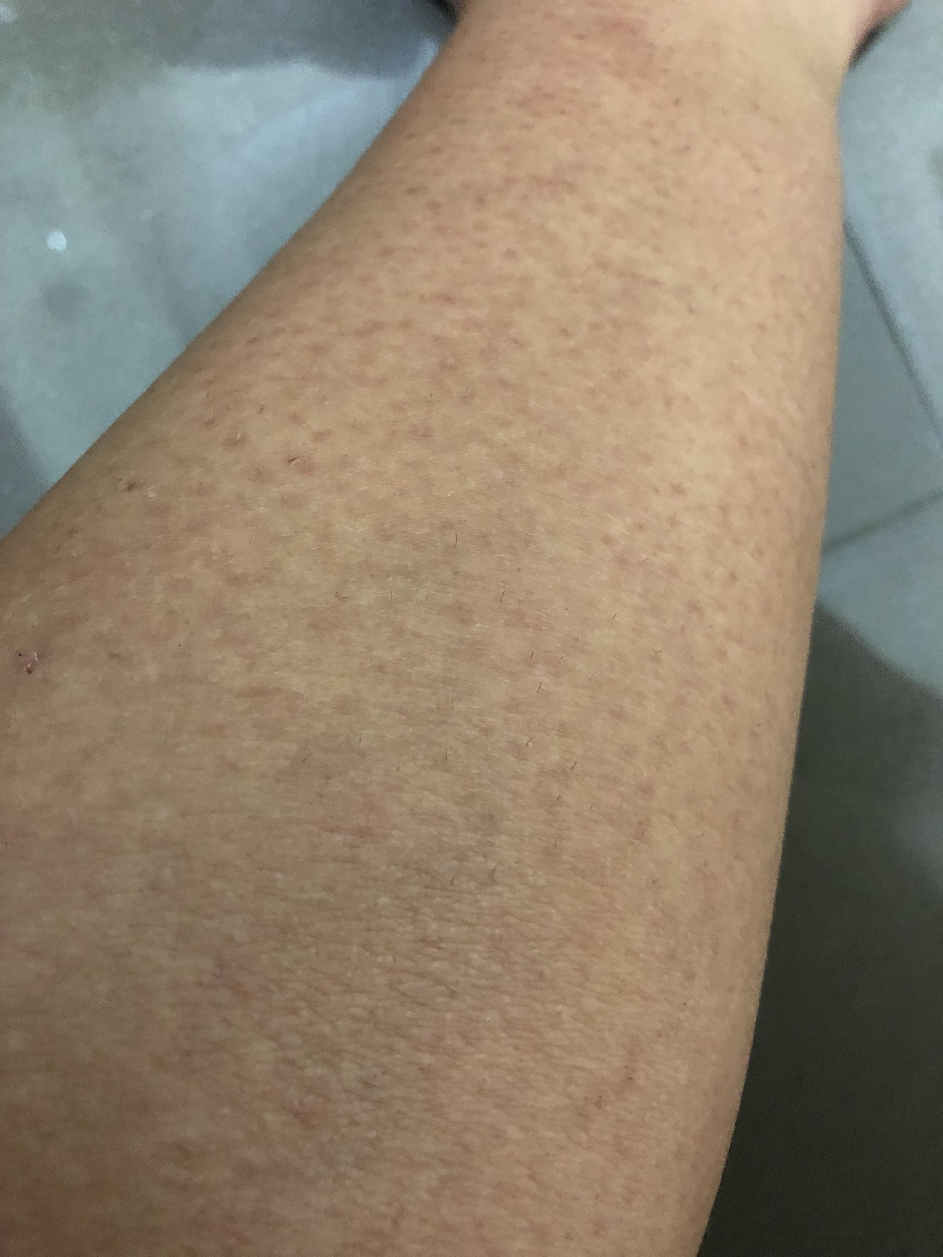 [Skin concern] my legs have started developing these odd spots(?) and