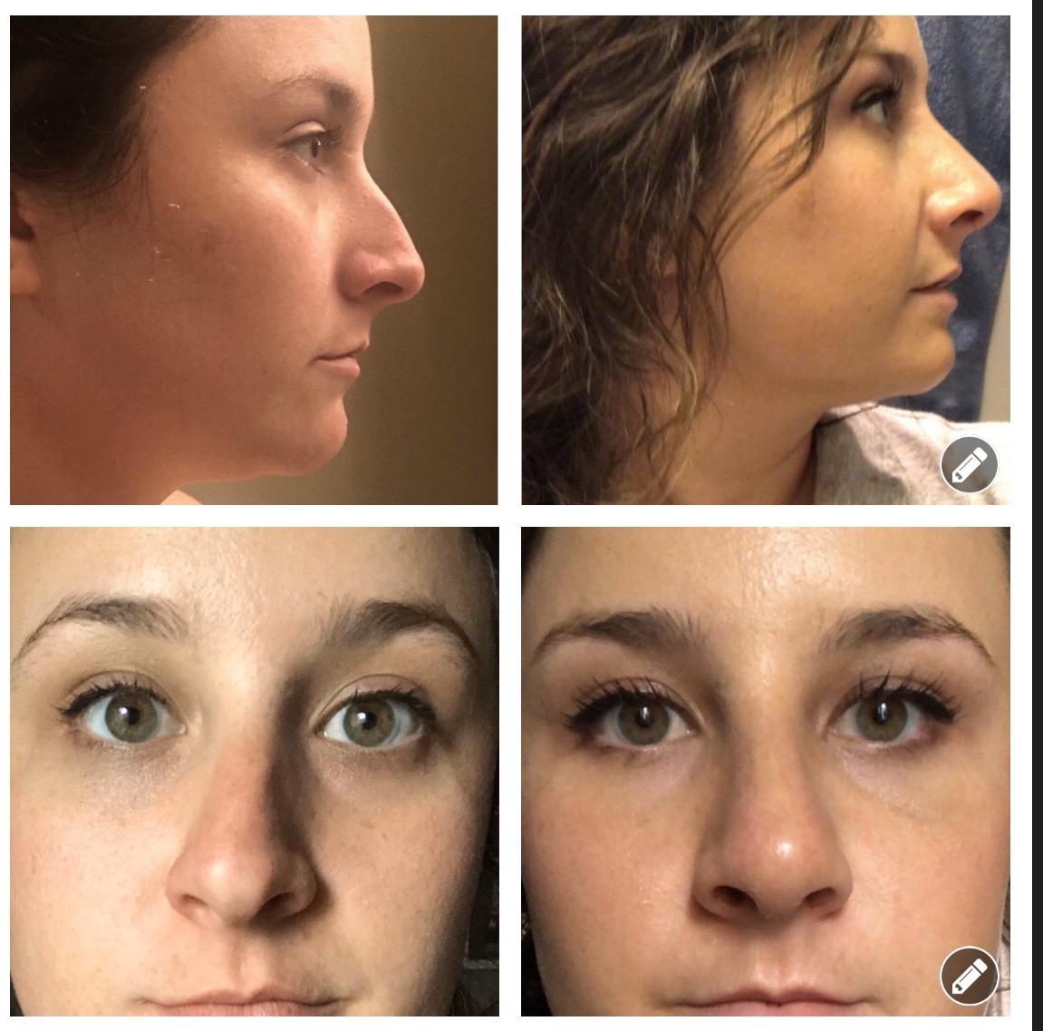 6 days post septorhinoplasty with turbinate reduction! r/PlasticSurgery