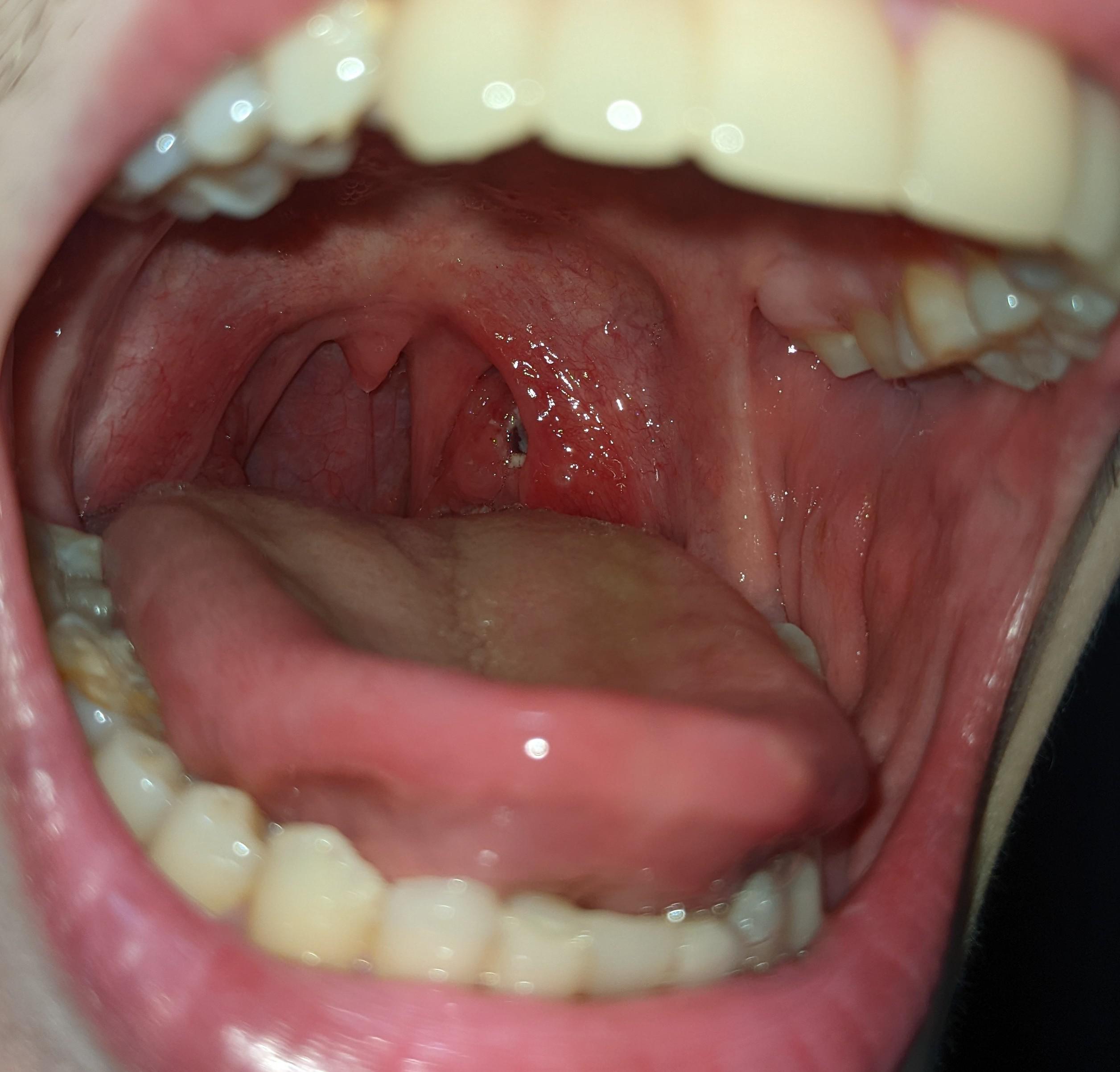 I have a slight tonsillitis and after eating some food got stuck in my