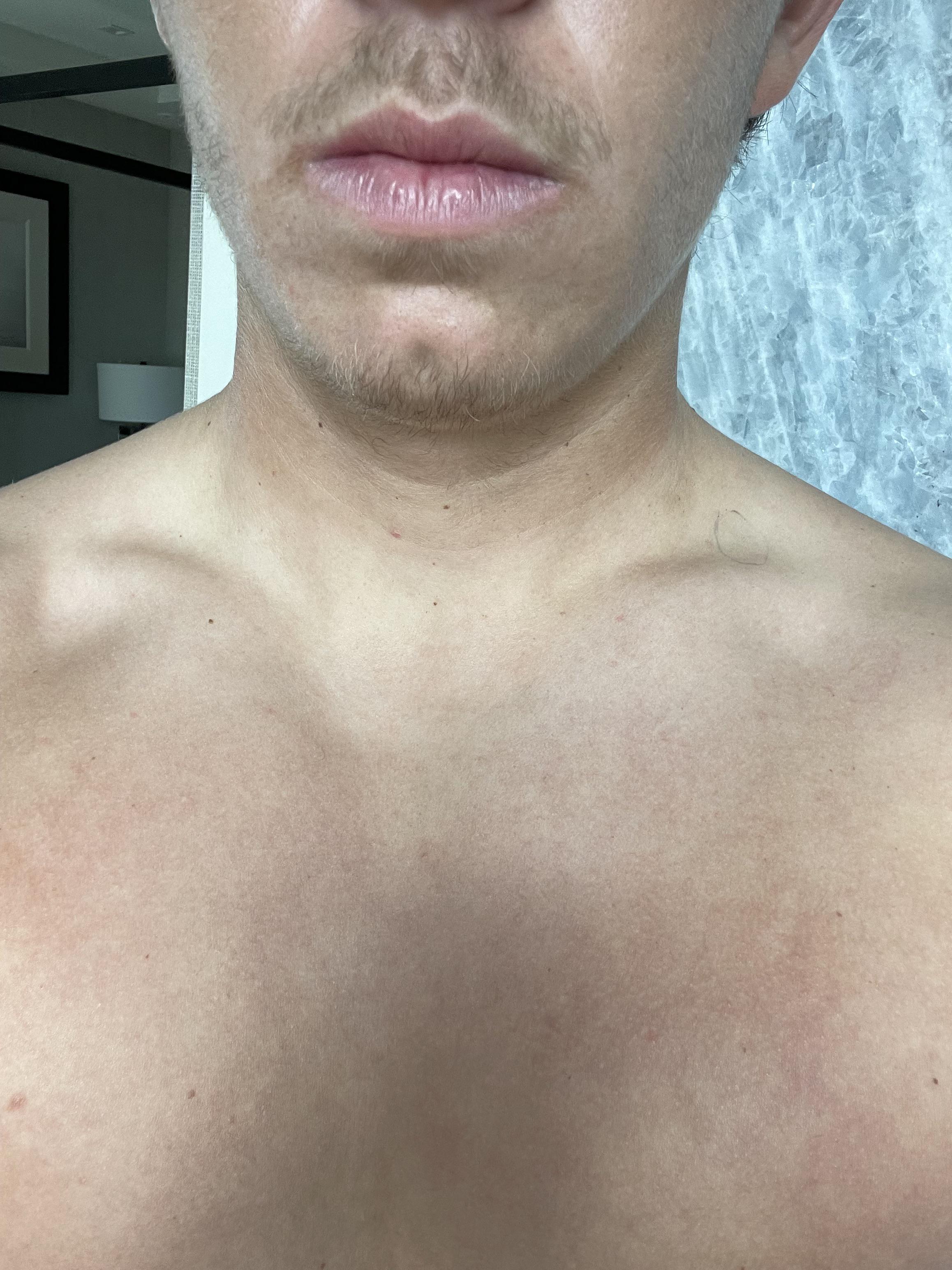 Swollen Lymph Nodes Collarbone