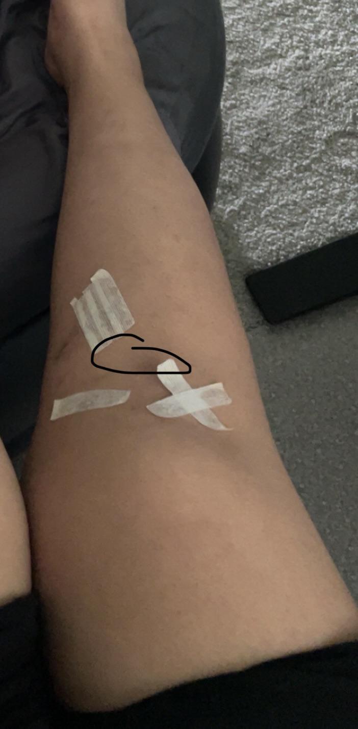 Sharp pain just below knee cap with quad sets and straight leg raises r/ACL