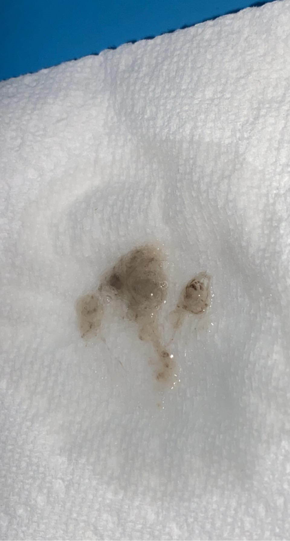 I’ve been spitting phlegm like this out when i clear my throat for about 3 months. 2 days ago