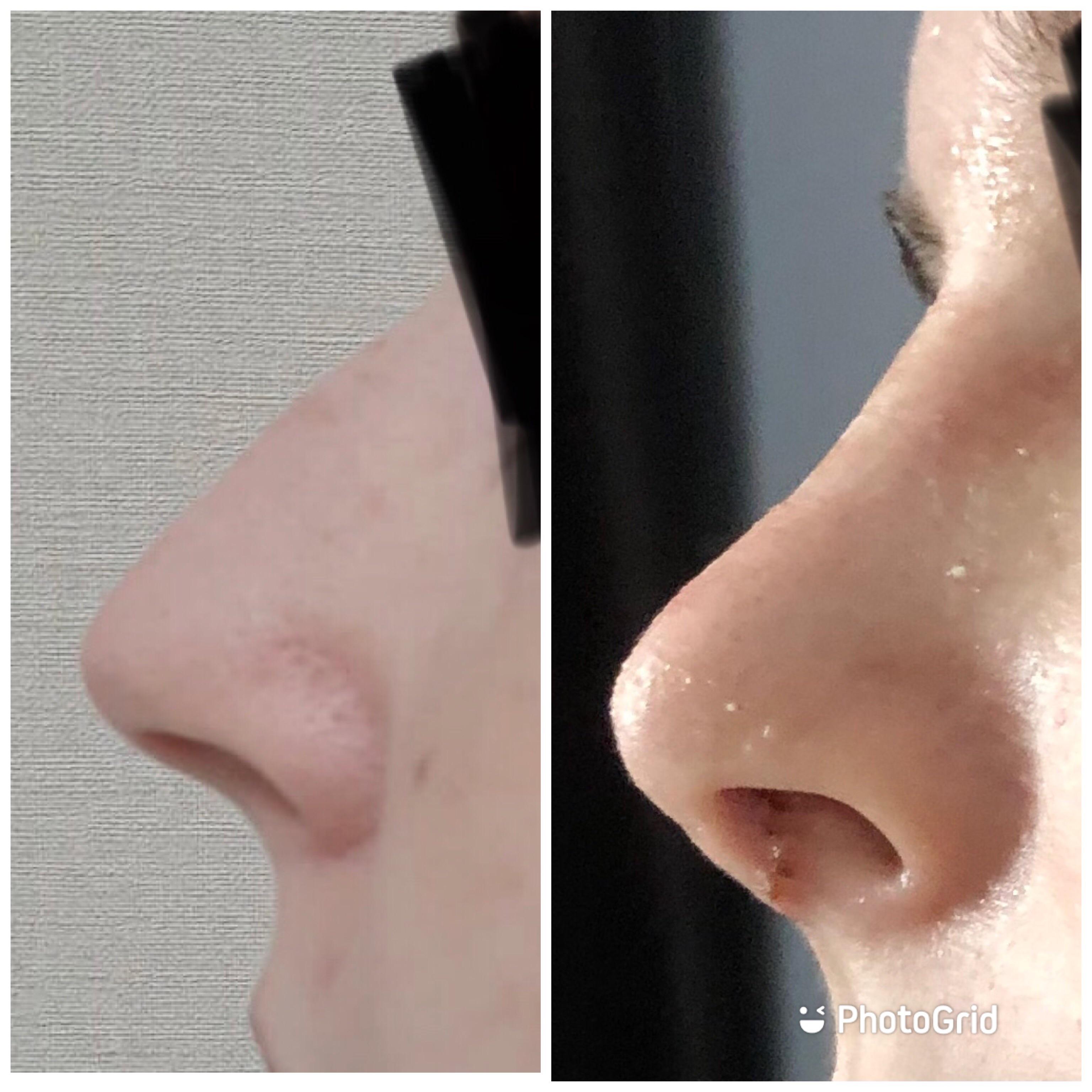 14 days post op. The stitches aren’t great and the tip is hard as a