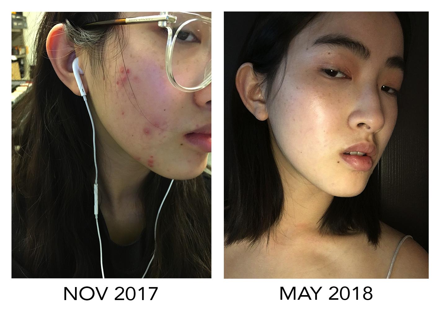 [B&A] controlling hormonal acne and hyperpigmentation progress r