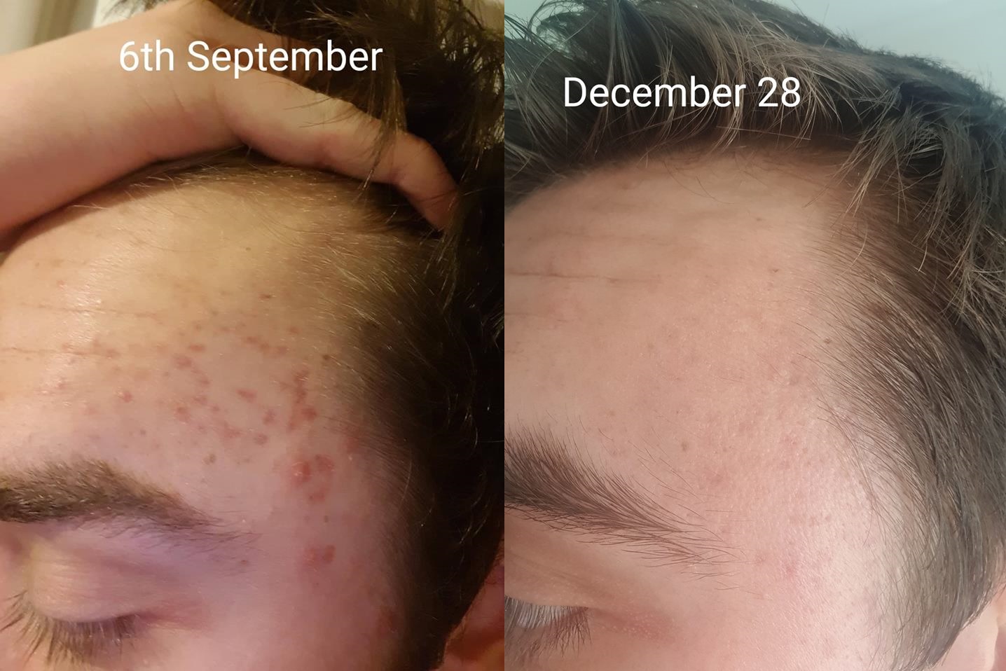 [Acne] Daily Tretinoin use and Two microneedling sessions results