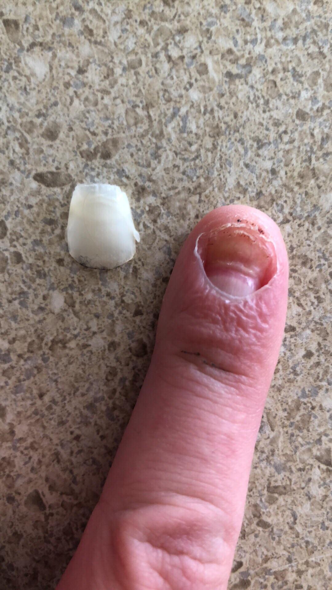 Aggregate more than 114 nail falling off best ceg.edu.vn