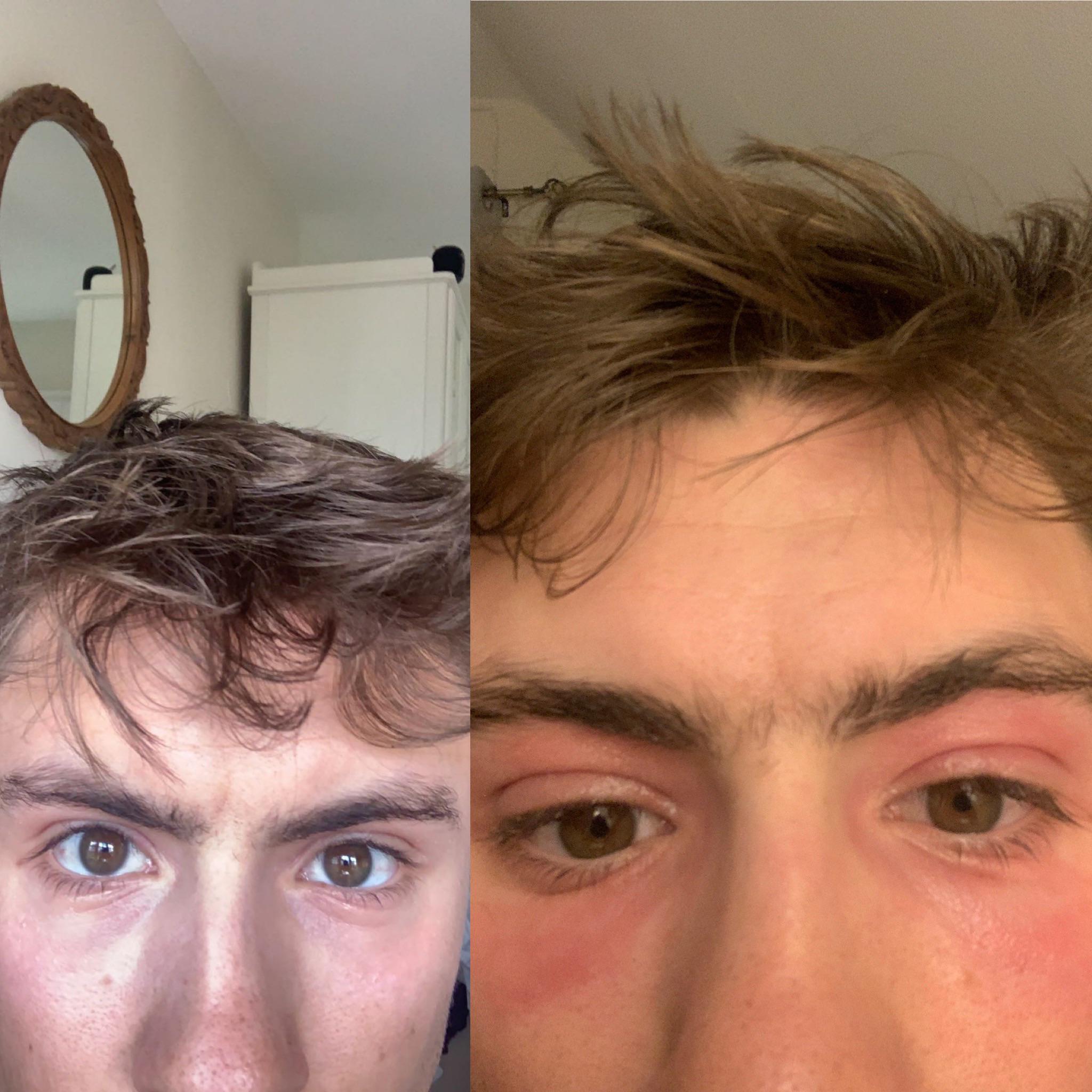 Thanks for all the advice about Protopic for eye eczema! These pictures