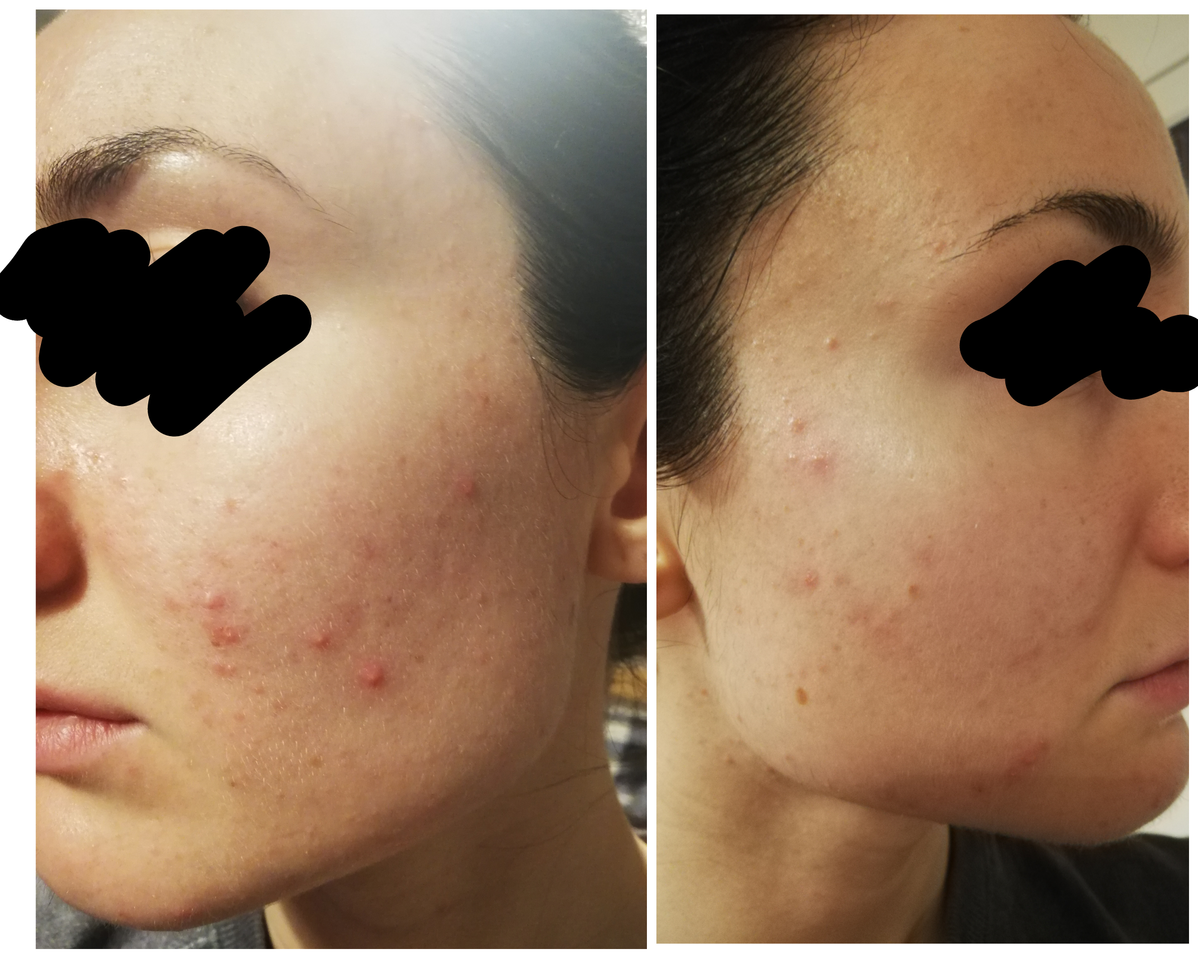 Poured my heart out to Acne Specialist. Prescribed Skinoren 20 cream