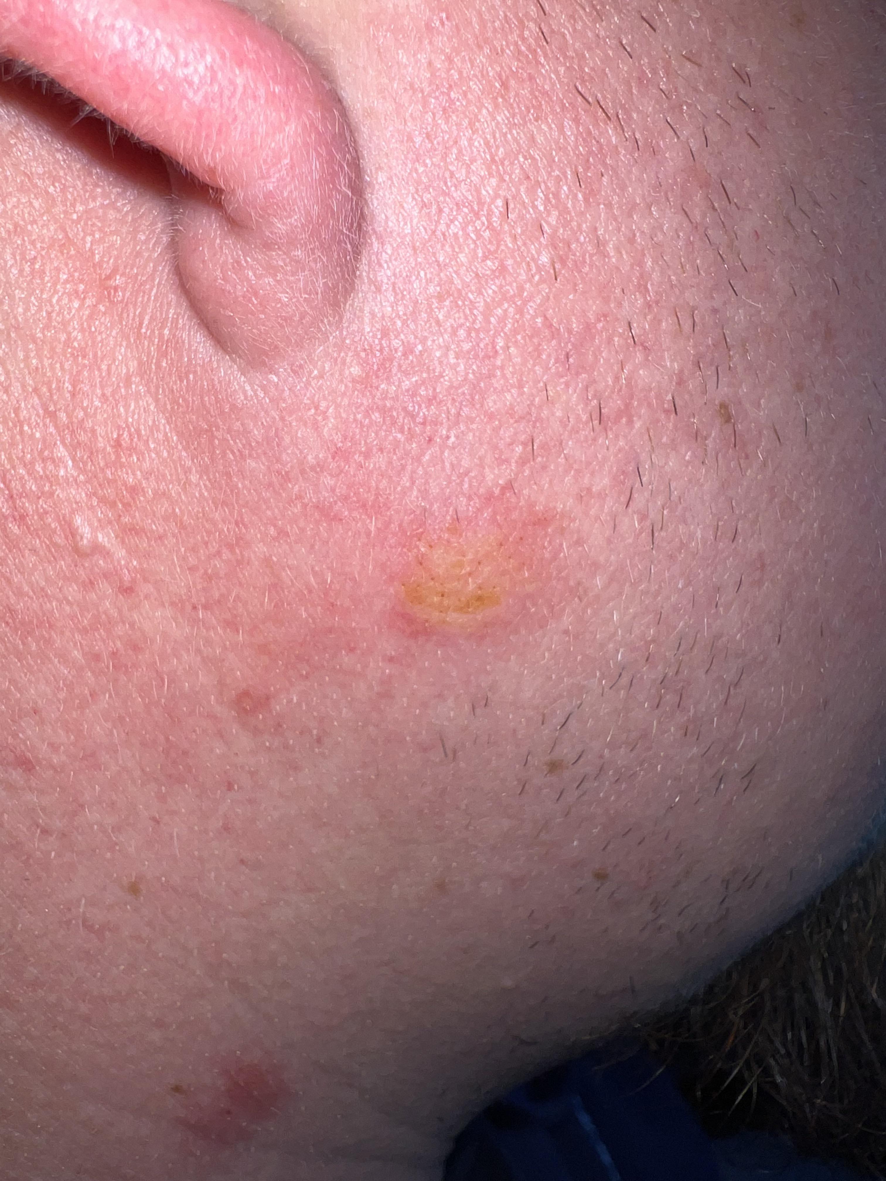 Hard yellow spot on cheek r/medical_advice