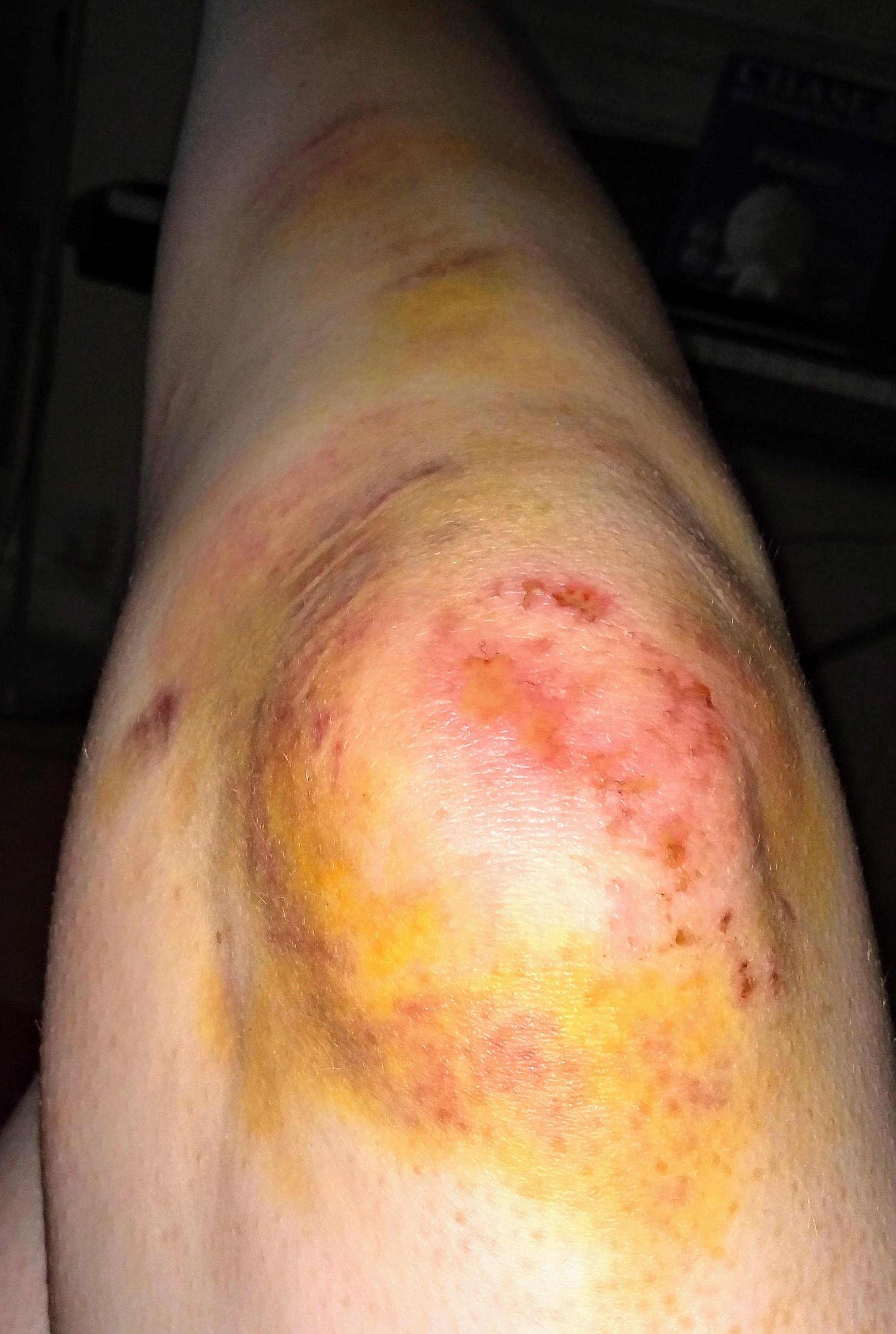 Got ran over by a car and didn't break a bone, just bruised. Proud